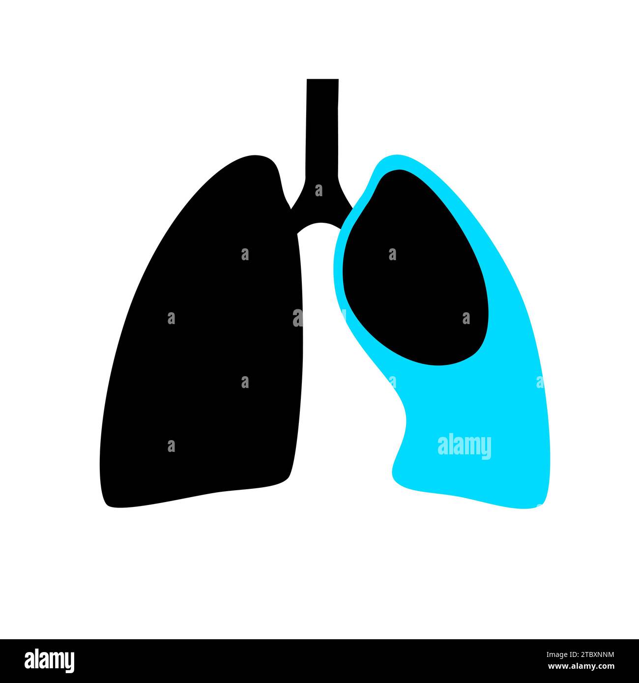 Pneumothorax, illustration Banque D'Images