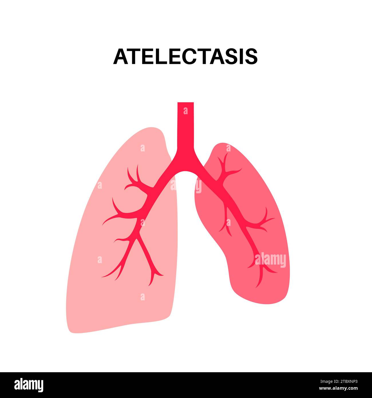 Atélectasie, illustration Banque D'Images
