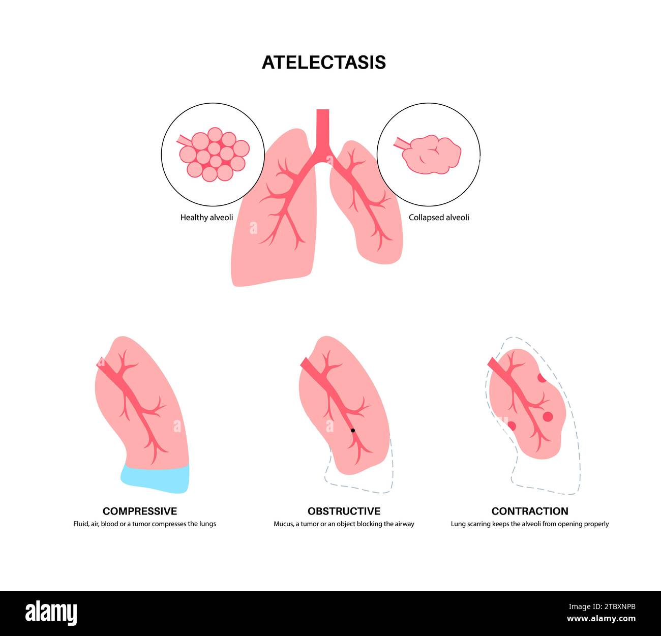 Atélectasie, illustration Banque D'Images