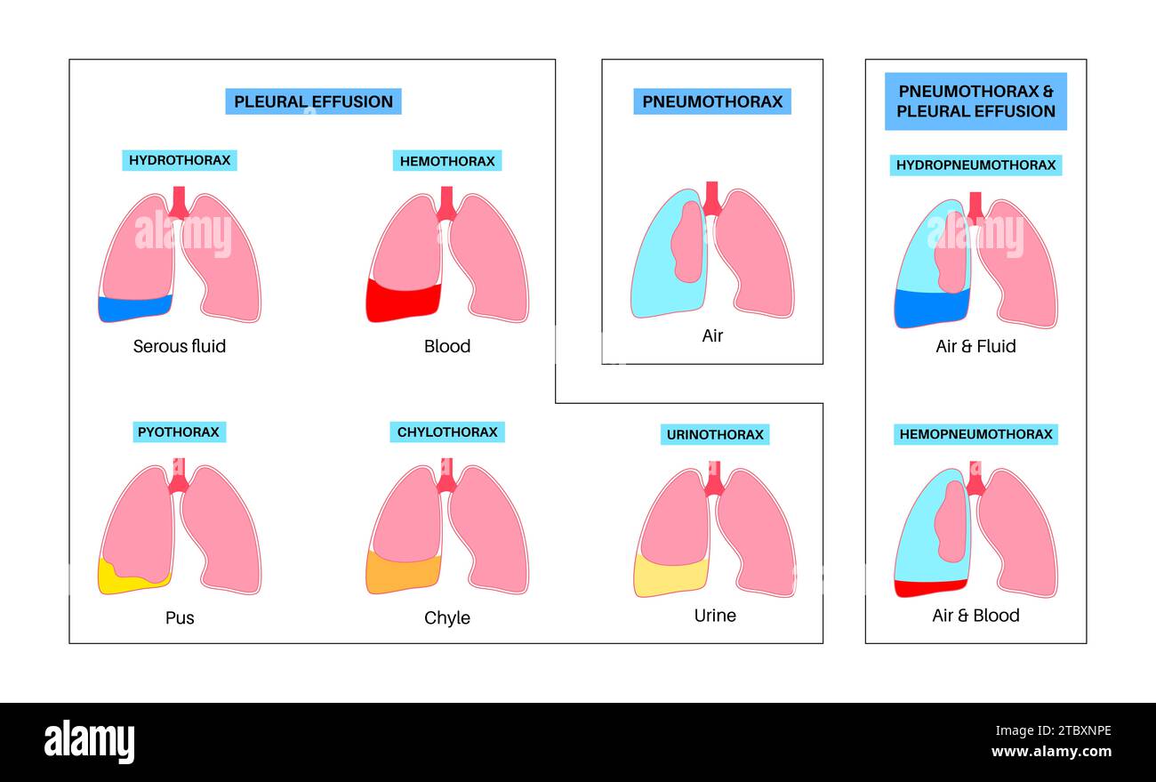 Épanchement pleural, illustration Banque D'Images