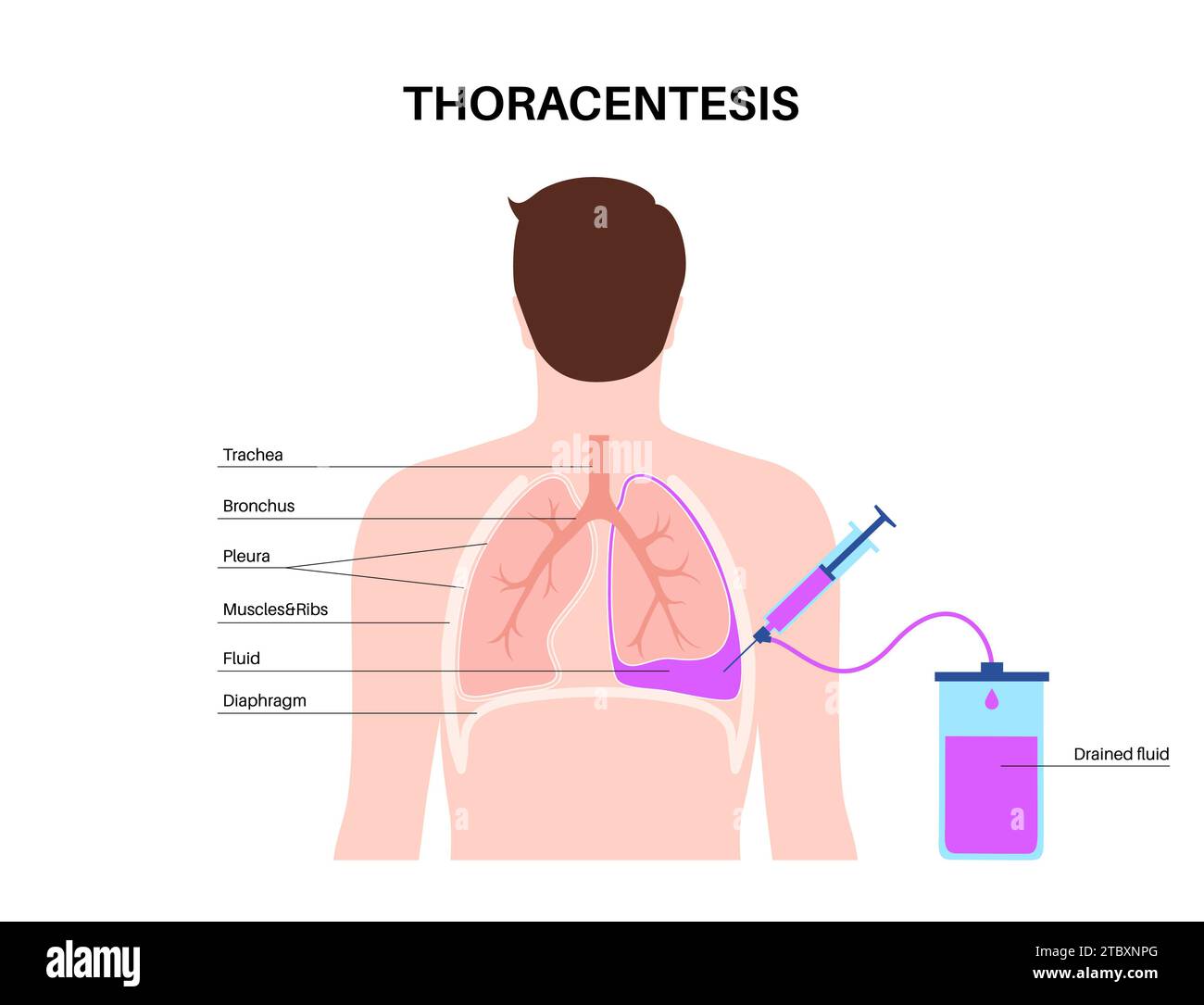 Intervention médicale de thoracentèse, illustration Banque D'Images