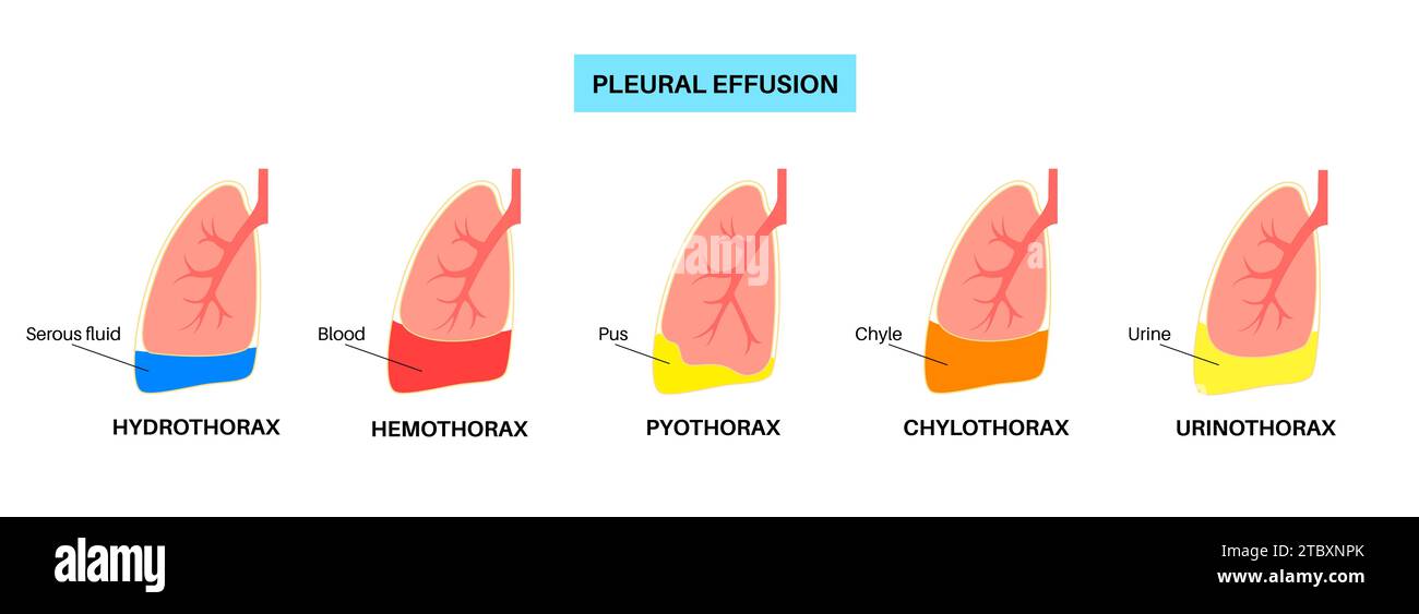 Épanchement pleural, illustration Banque D'Images
