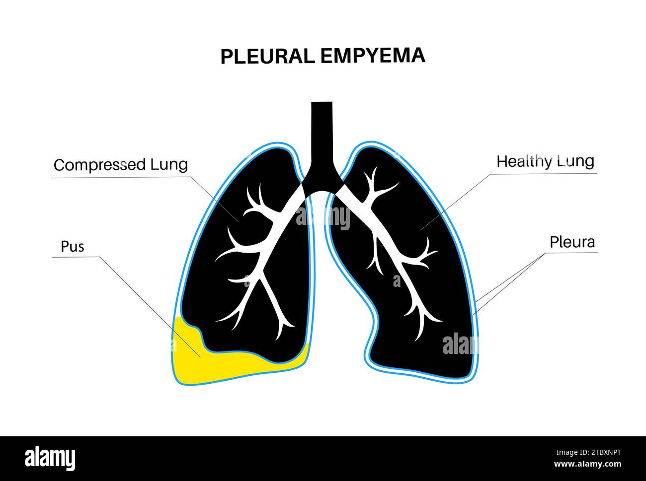 Pyothorax, illustration Banque D'Images