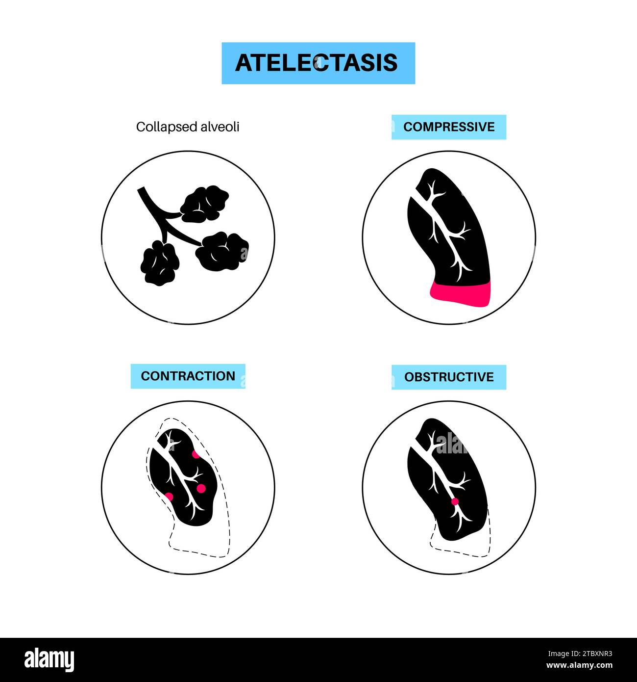 Atélectasie, illustration Banque D'Images
