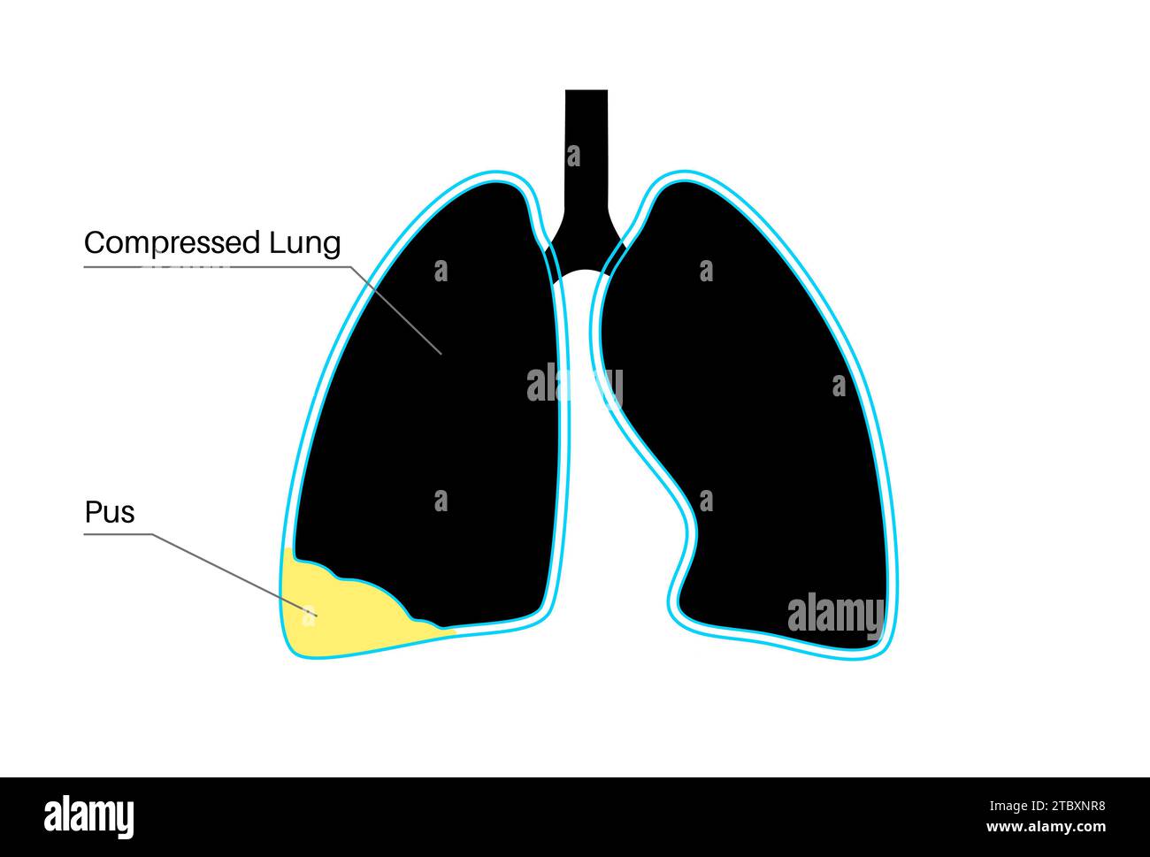 Pyothorax, illustration Banque D'Images