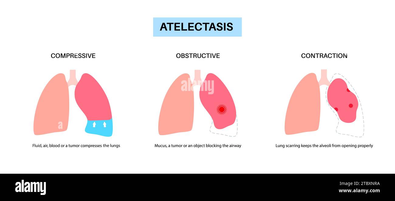 Atélectasie, illustration Banque D'Images