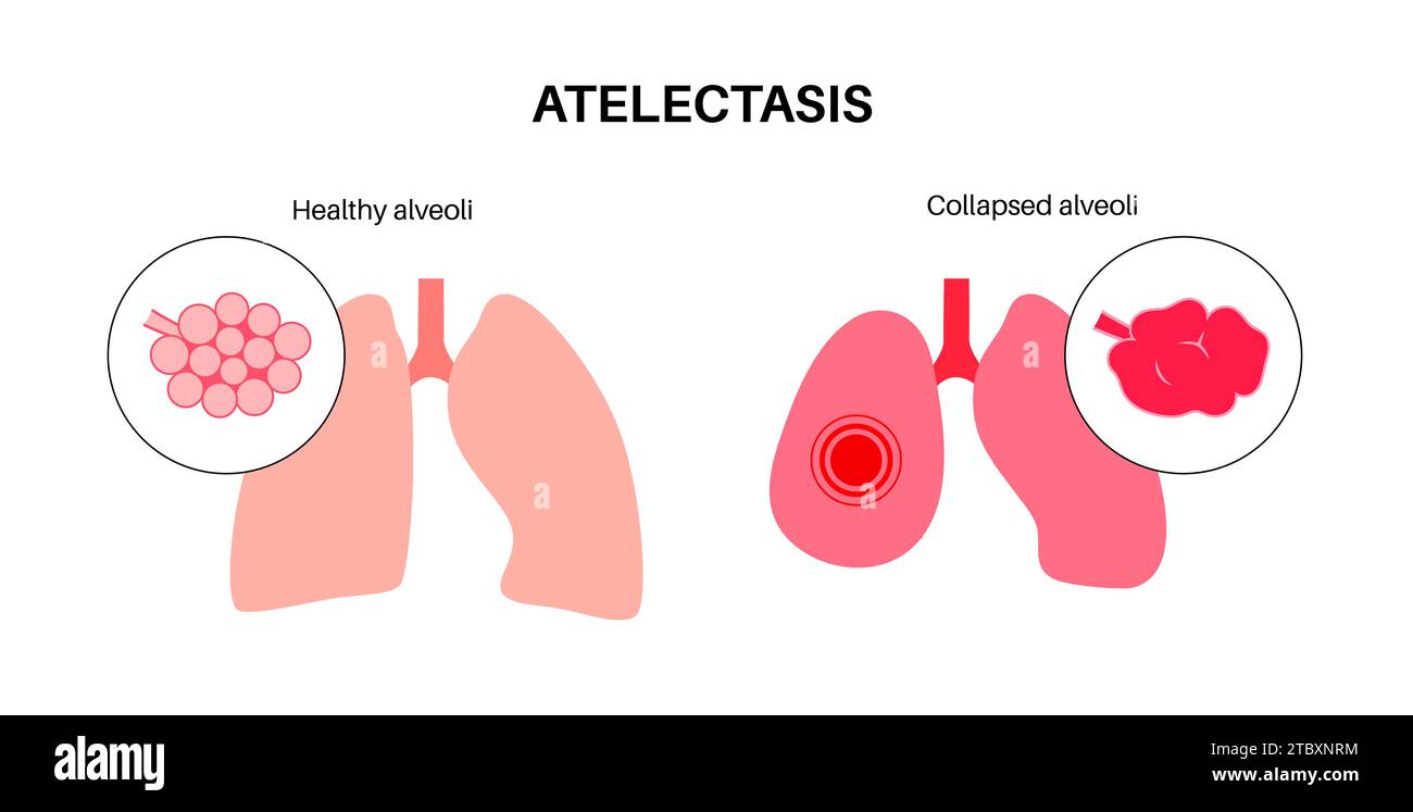 Atélectasie, illustration Banque D'Images