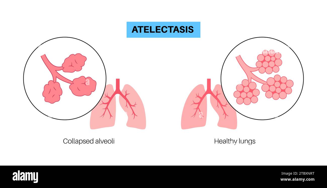 Atélectasie, illustration Banque D'Images