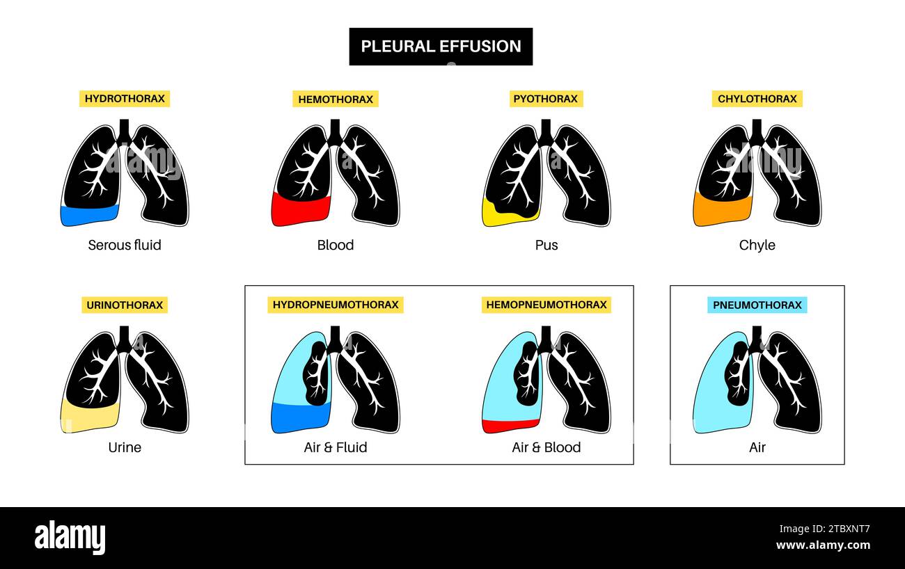 Épanchement pleural, illustration Banque D'Images