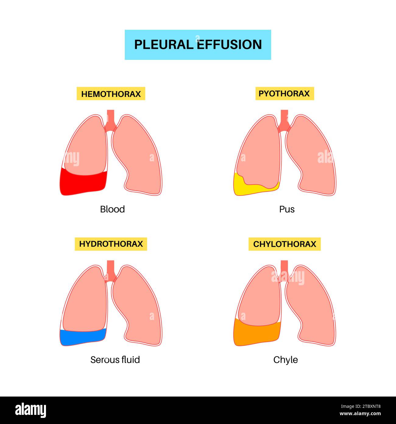 Épanchement pleural, illustration Banque D'Images