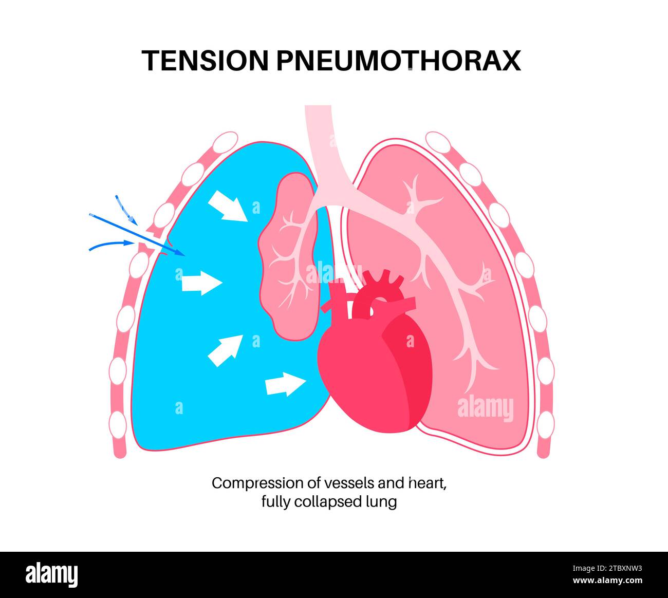 Pneumothorax de tension, illustration Banque D'Images