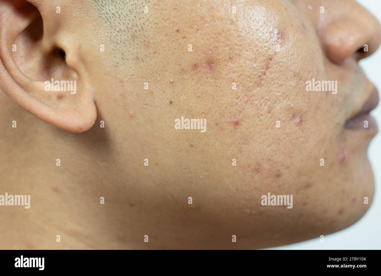 problèmes cutanés. problème de l'acné enflammée sur le visage. Acné enflammée se compose de gonflement, rougeur, et pores qui sont sévèrement obstrués par des bactéries, o Banque D'Images
