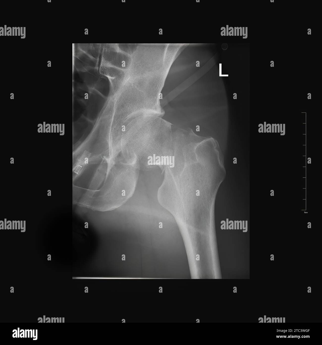 Fracture cervicale gauche. Fracture du col fémoral. Photo radio d'un homme Banque D'Images