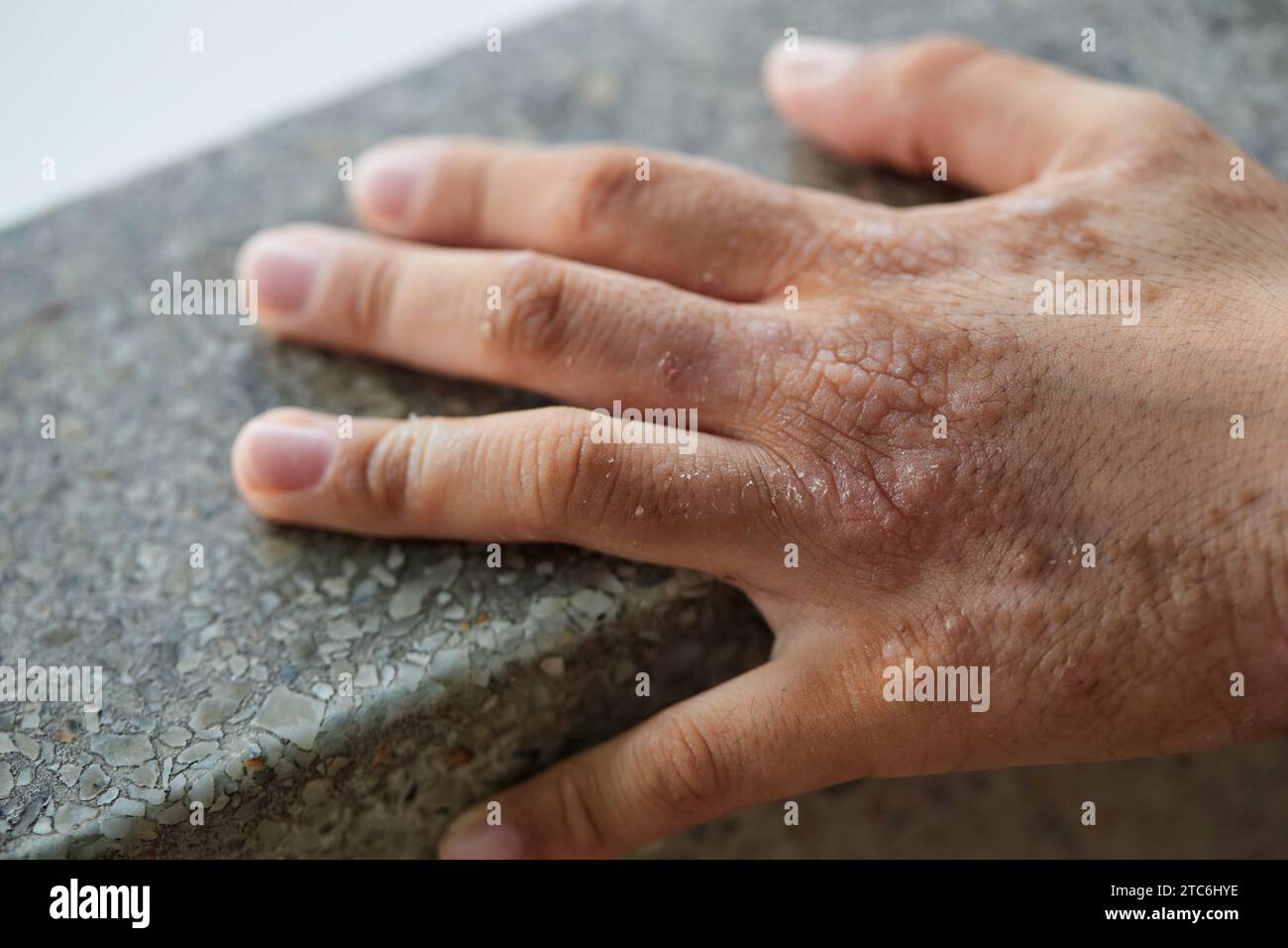 Gros plan sur la dermatite chronique de dermatoses Banque D'Images