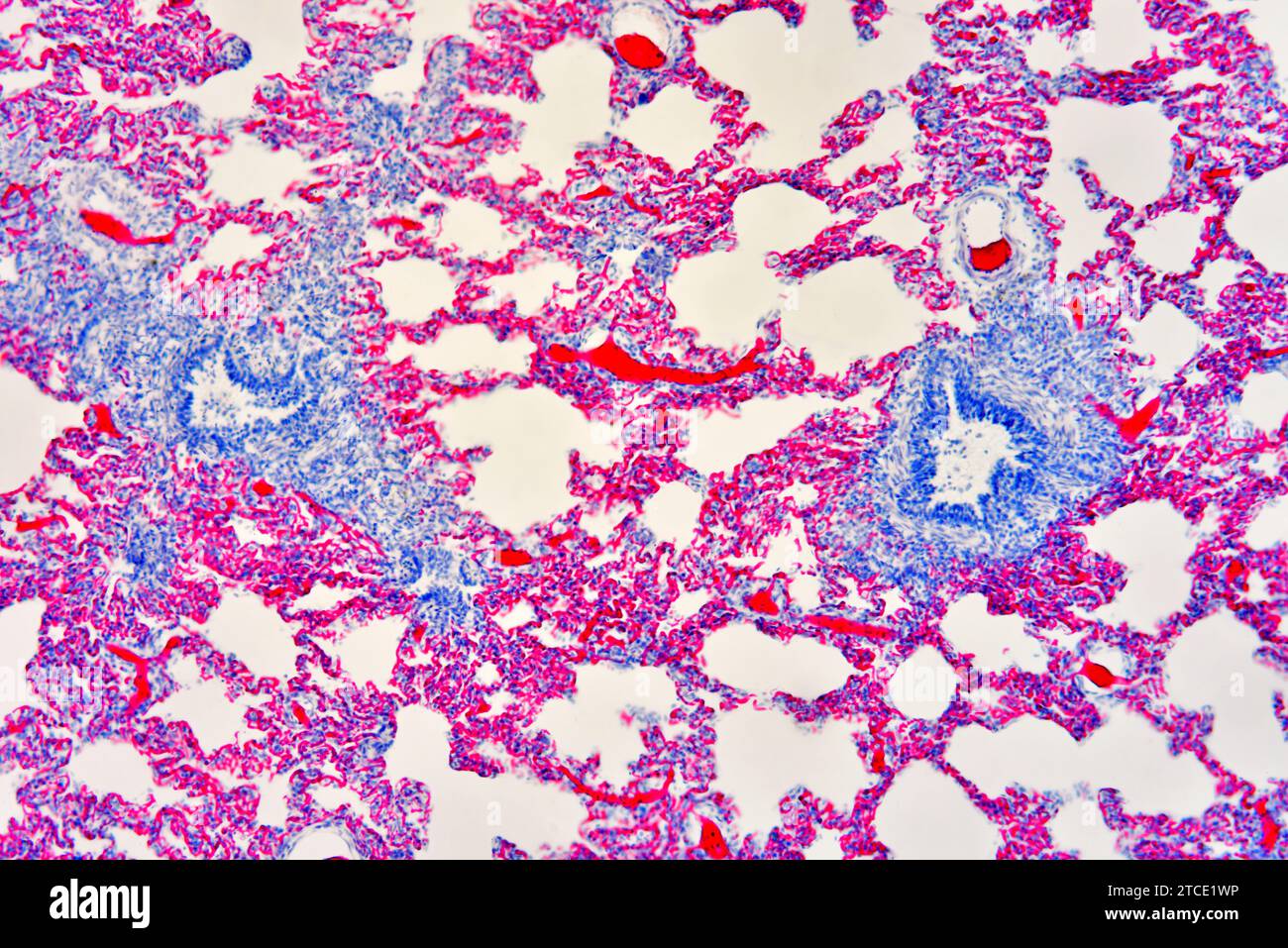 Section pulmonaire humaine montrant des alvéoles, des bronchioles et des vaisseaux sanguins. Microscope optique X100. Banque D'Images