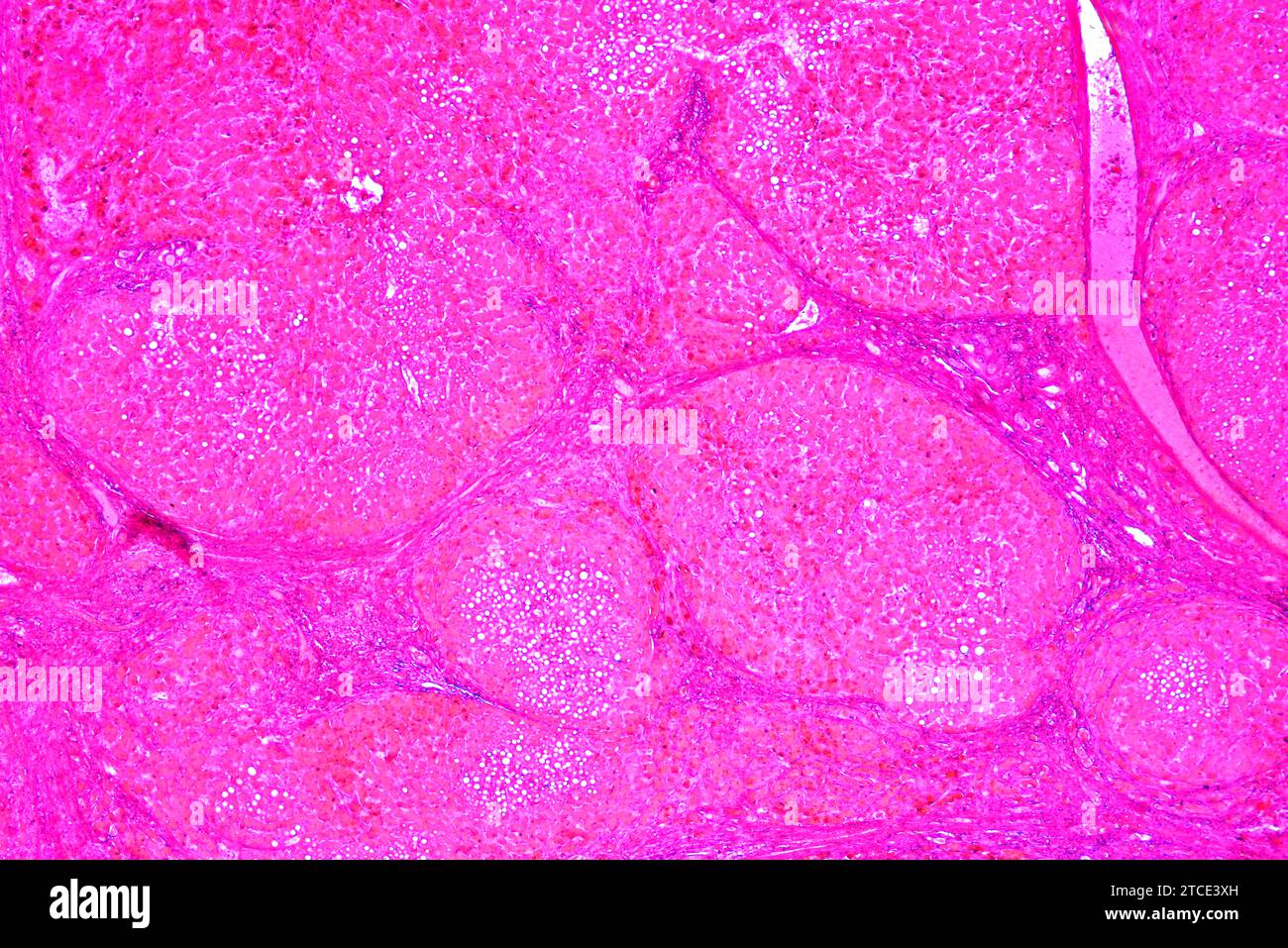 Foie humain avec cirrhose. Microscope optique X40. Banque D'Images