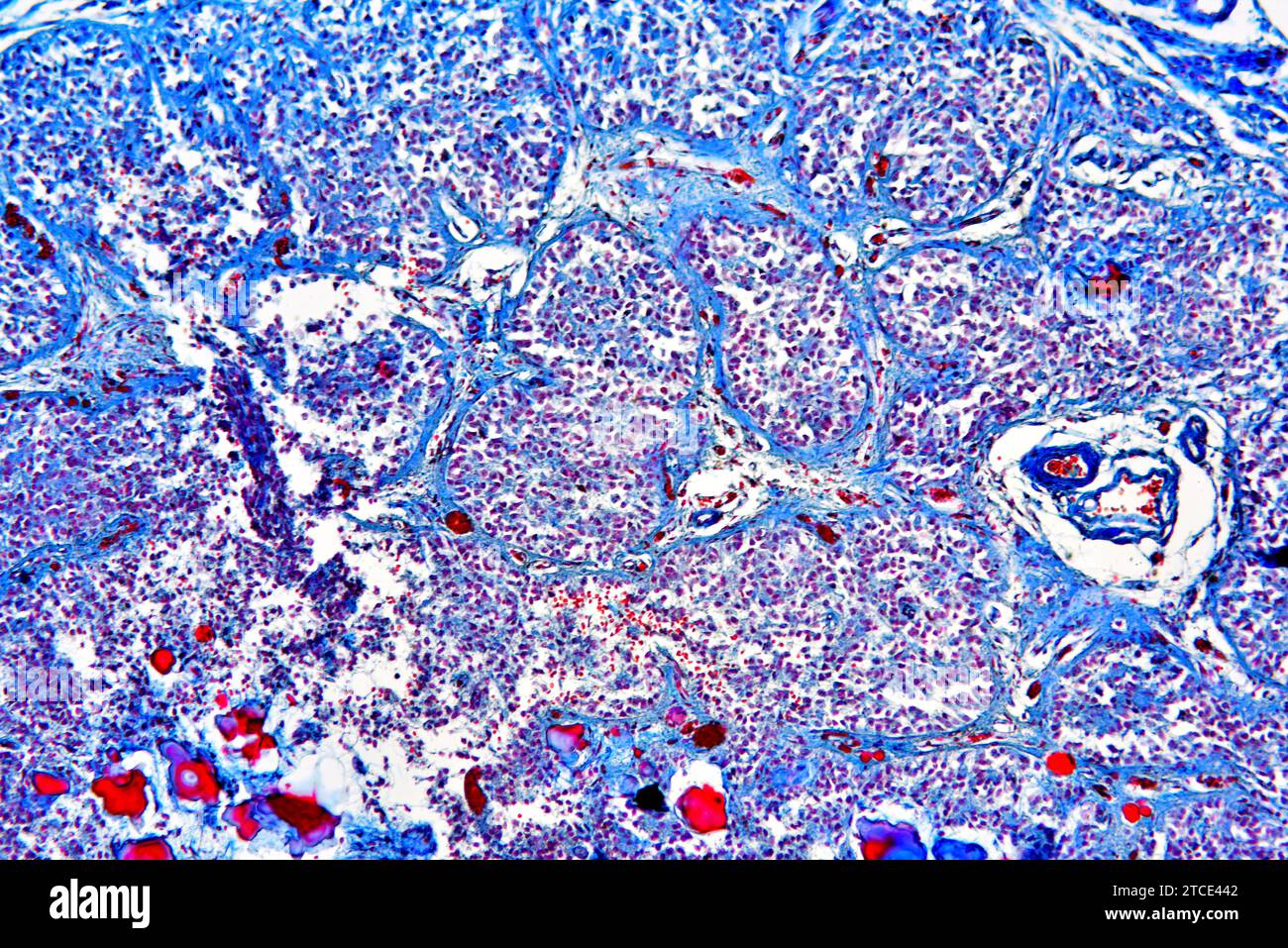 Glande pinéale normale produisant de la mélatonine et de la sérotonine. Microscope optique X100. Banque D'Images