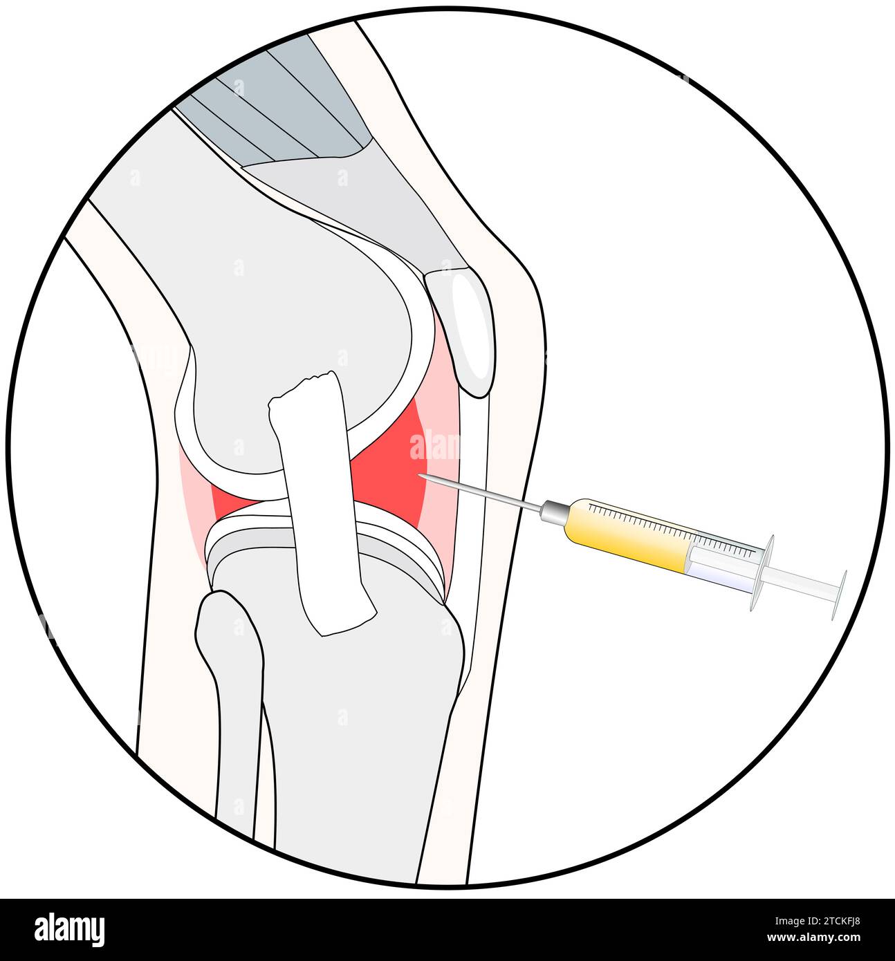 Injection au genou. Pictogramme stylisé pour la conception Web, ou application mobile sur la biotechnologie prp, l'injection d'acide hyaluronique, ou la procédure médicale pour ostéoart Illustration de Vecteur