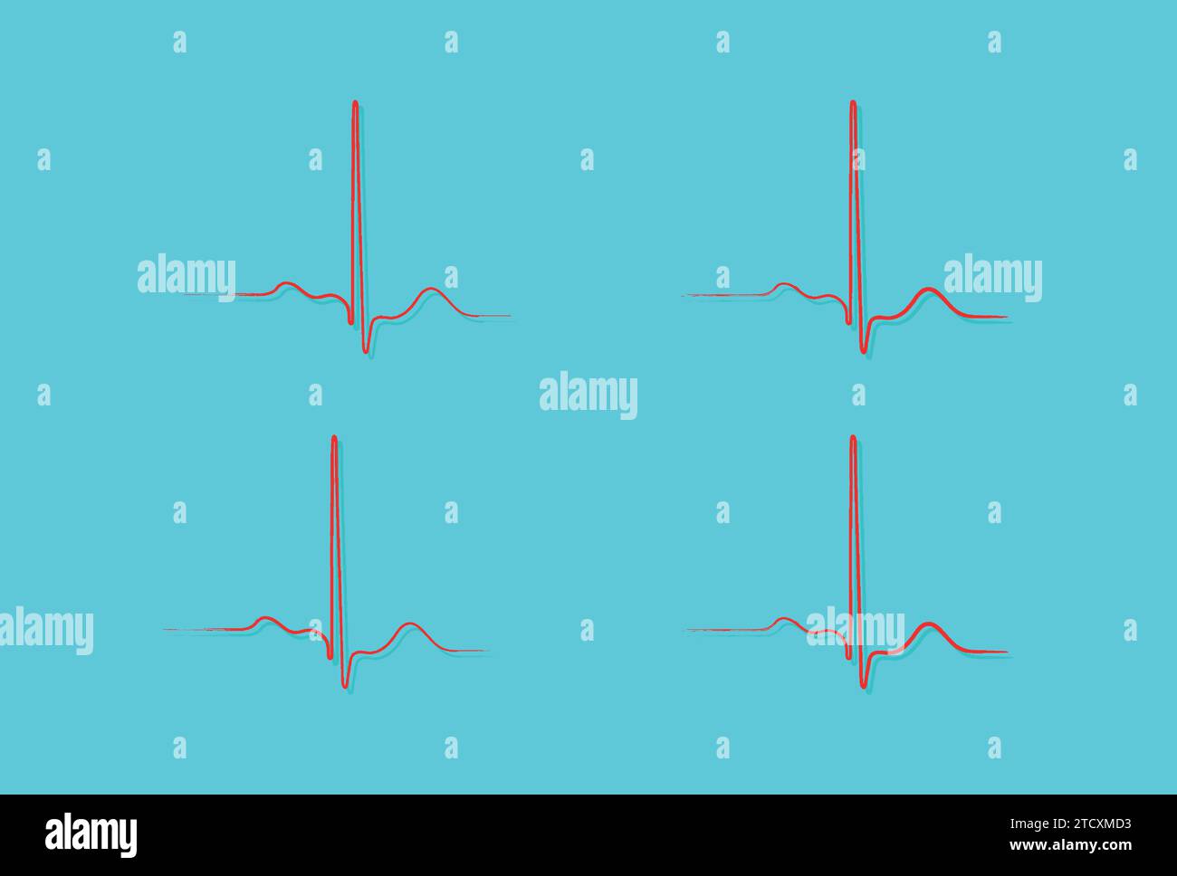 Repolarisation ventriculaire, cycle cardiaque, ECG du coeur en rythme sinusal normal, intervalle QT de l'ECG. Illustration de Vecteur