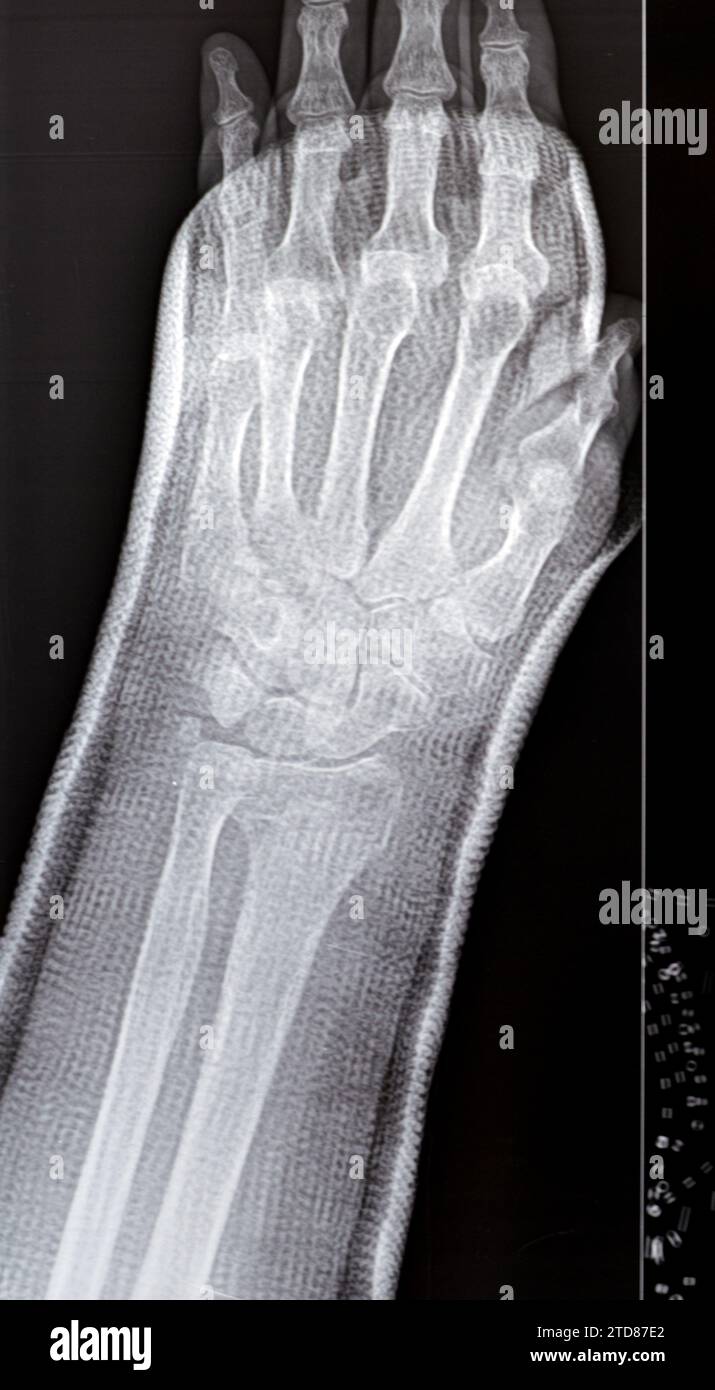 Réduction de fracture colles d'une vieille femelle, un type de fracture de l'avant-bras distal, l'extrémité cassée du RADIUS est pliée vers l'arrière, à la suite d'un Banque D'Images