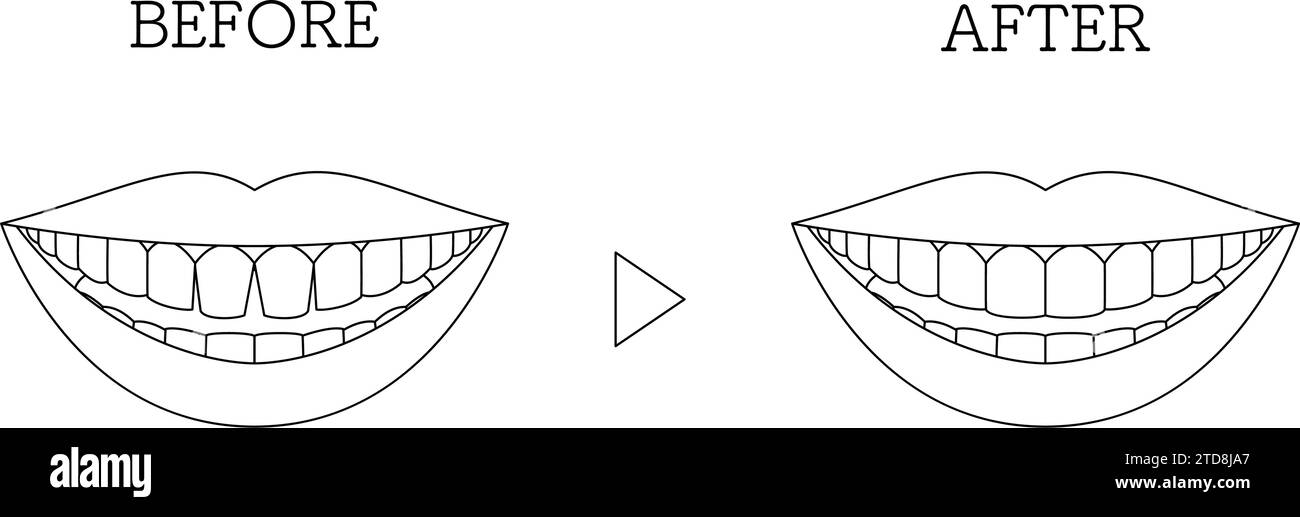 Dentisterie cosmétique, collage direct avant et après, entailles des dents antérieures, Illustration vectorielle Illustration de Vecteur