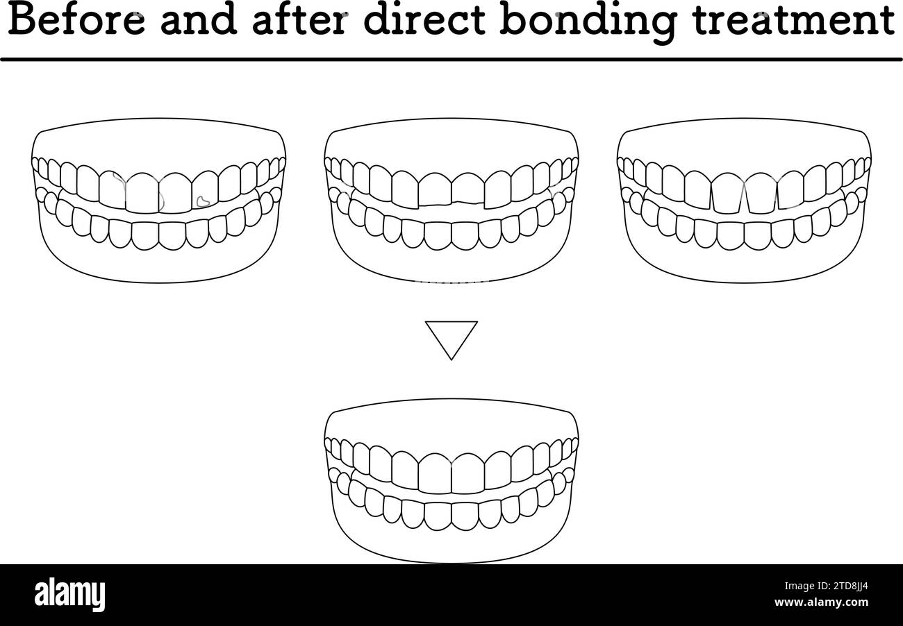 Dentisterie esthétique : traitement avec collage direct, dents caries ou ébréchées, et espaces, Illustration vectorielle Illustration de Vecteur