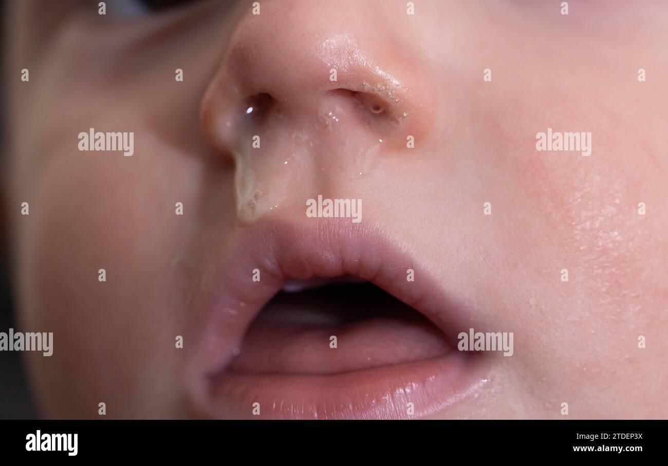 Gros plan du visage et du nez d'un petit enfant avec snot. Le concept de rhume, rhinite et écoulement nasal chez l'enfant, allergie Banque D'Images