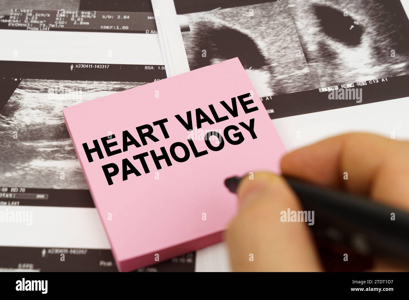 Concept médical. Sur les images échographiques, il y a des autocollants qui disent - pathologie des valves cardiaques Banque D'Images