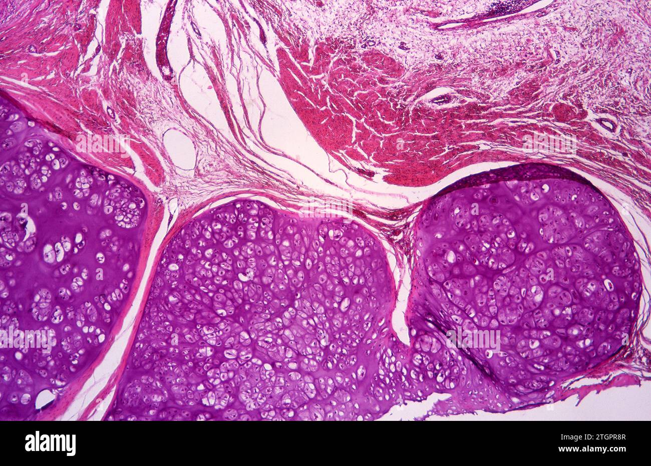 Chondroma sur l'os pubien. Chondroma est une tumeur cartilagineuse bénigne. Photomicrographe. Banque D'Images