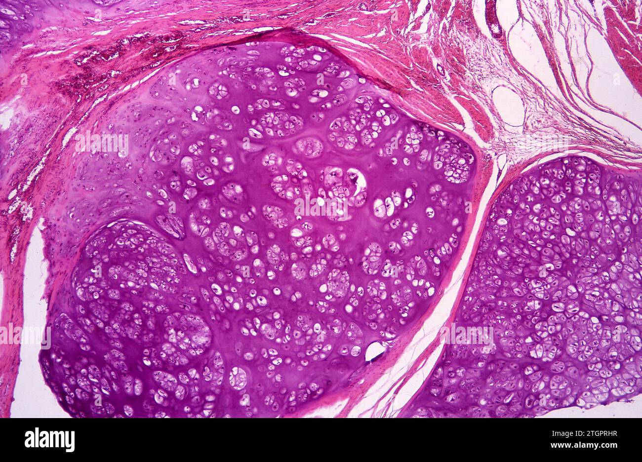 Chondroma sur l'os pubien. Chondroma est une tumeur cartilagineuse bénigne. Photomicrographe. Banque D'Images