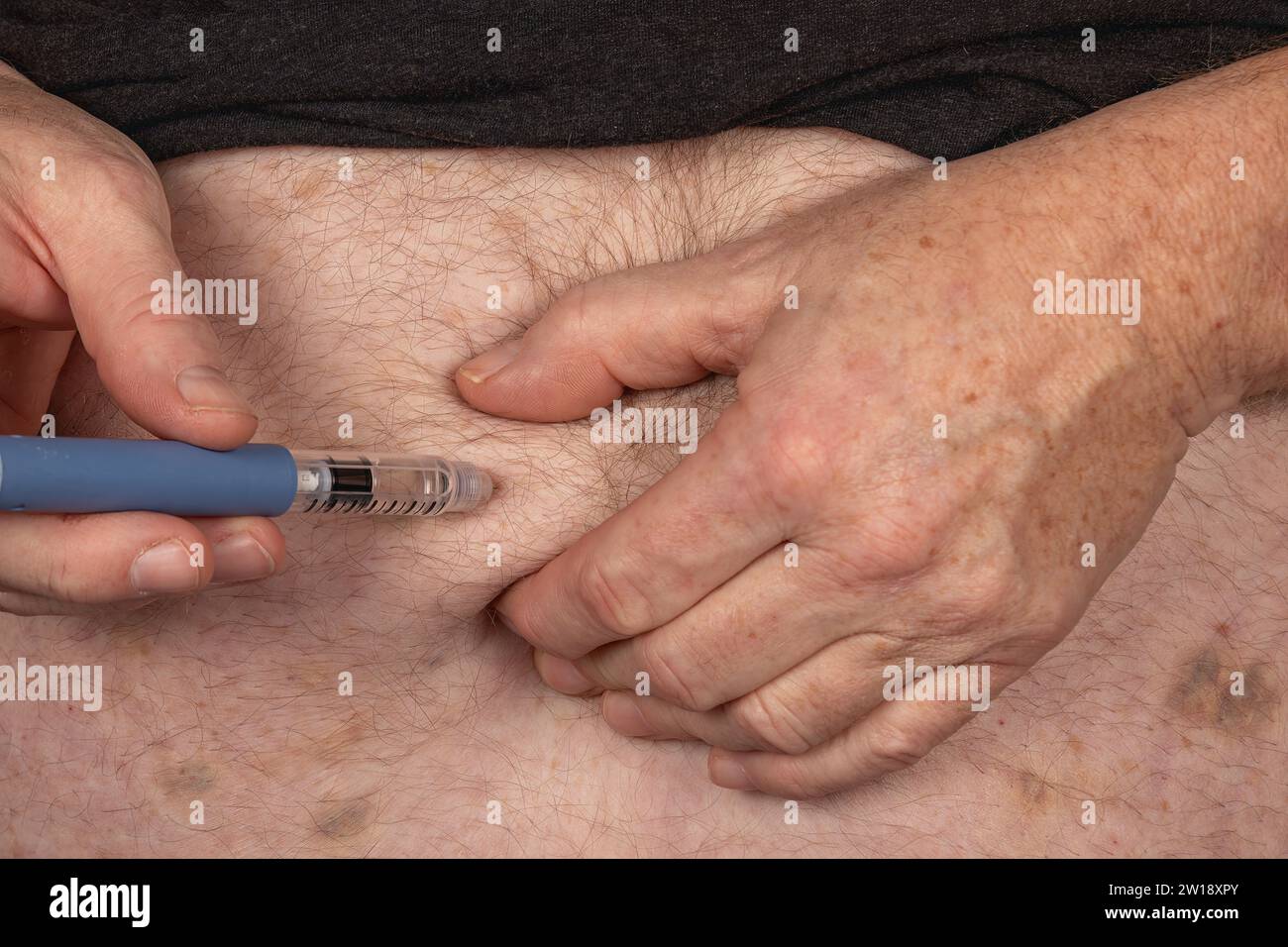 Prise en charge du diabète : injection d'insuline dans le ventre avec Insulin Pen Banque D'Images