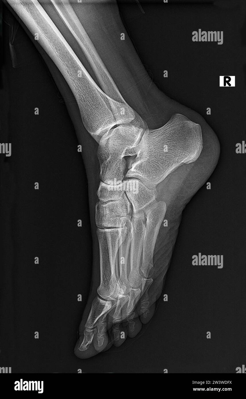 Radiographie normale, radiographie ou radiographie de l'articulation du pied et de la cheville en projection latérale, traumatologie et orthopédie, rhumatologie Banque D'Images