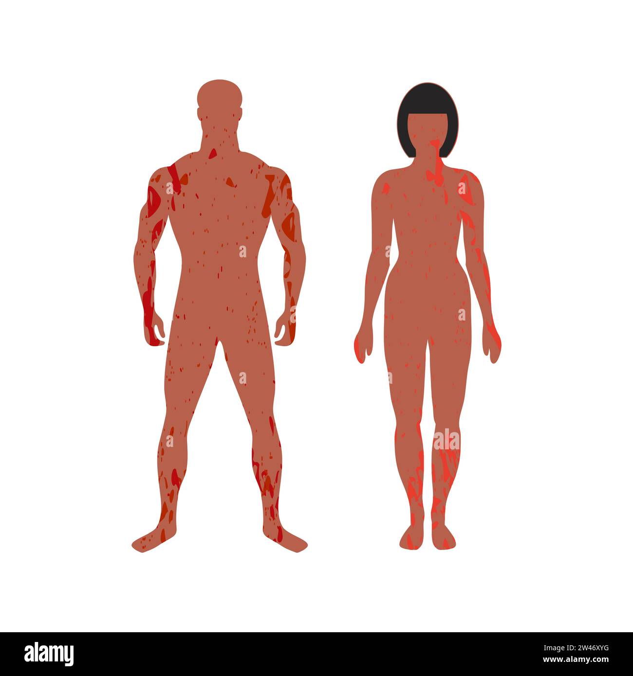 Homme et femme avec éruption cutanée douloureuse. Les taches recouvrent leur corps entier. Maladie de la peau ou trouble de la pigmentation. Silhouettes de patients. Méningite ou dermatite Illustration de Vecteur