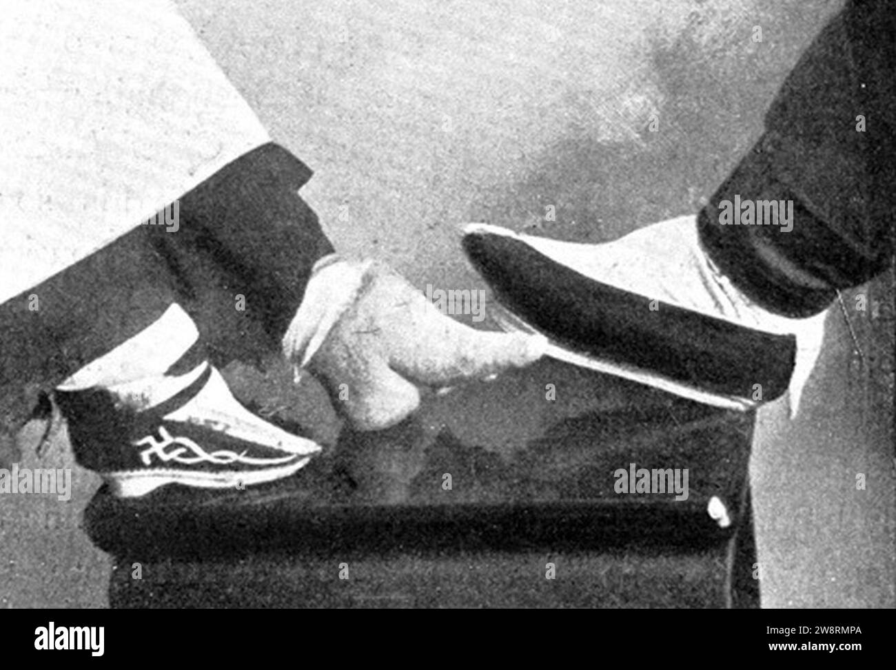 PIED NATUREL DE LA FEMME, ET PIEDS D'UNE AUTRE FEMME LIÉS À 6 POUCES. Par le Dr Garner. Banque D'Images