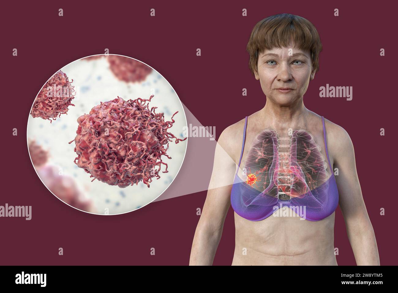 Illustration de la partie supérieure d'une femme avec la peau transparente, révélant la présence d'un cancer du poumon, et une vue rapprochée des cellules cancéreuses. Banque D'Images