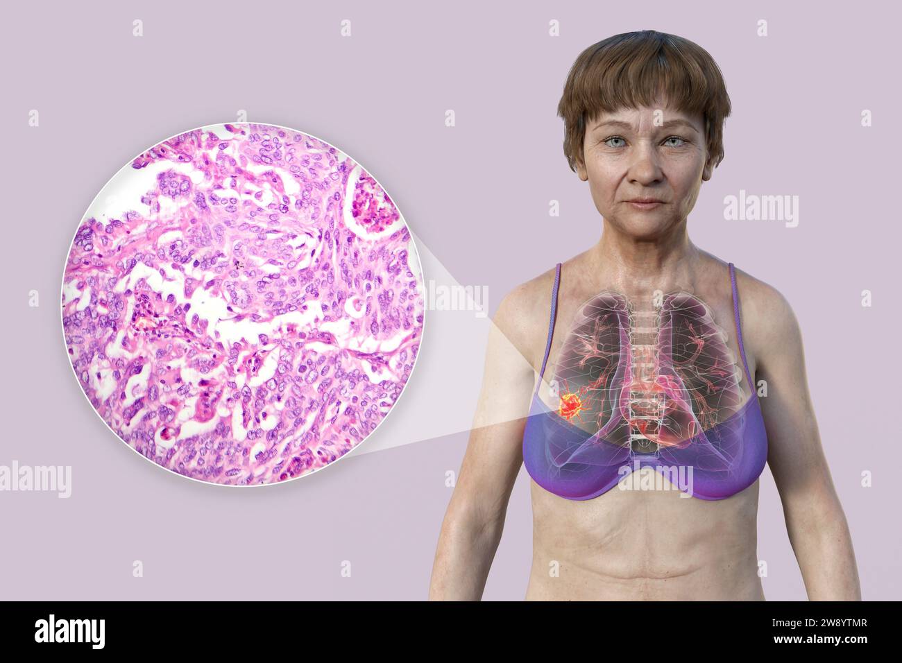 Femme atteinte d'un cancer du poumon, illustration Banque D'Images