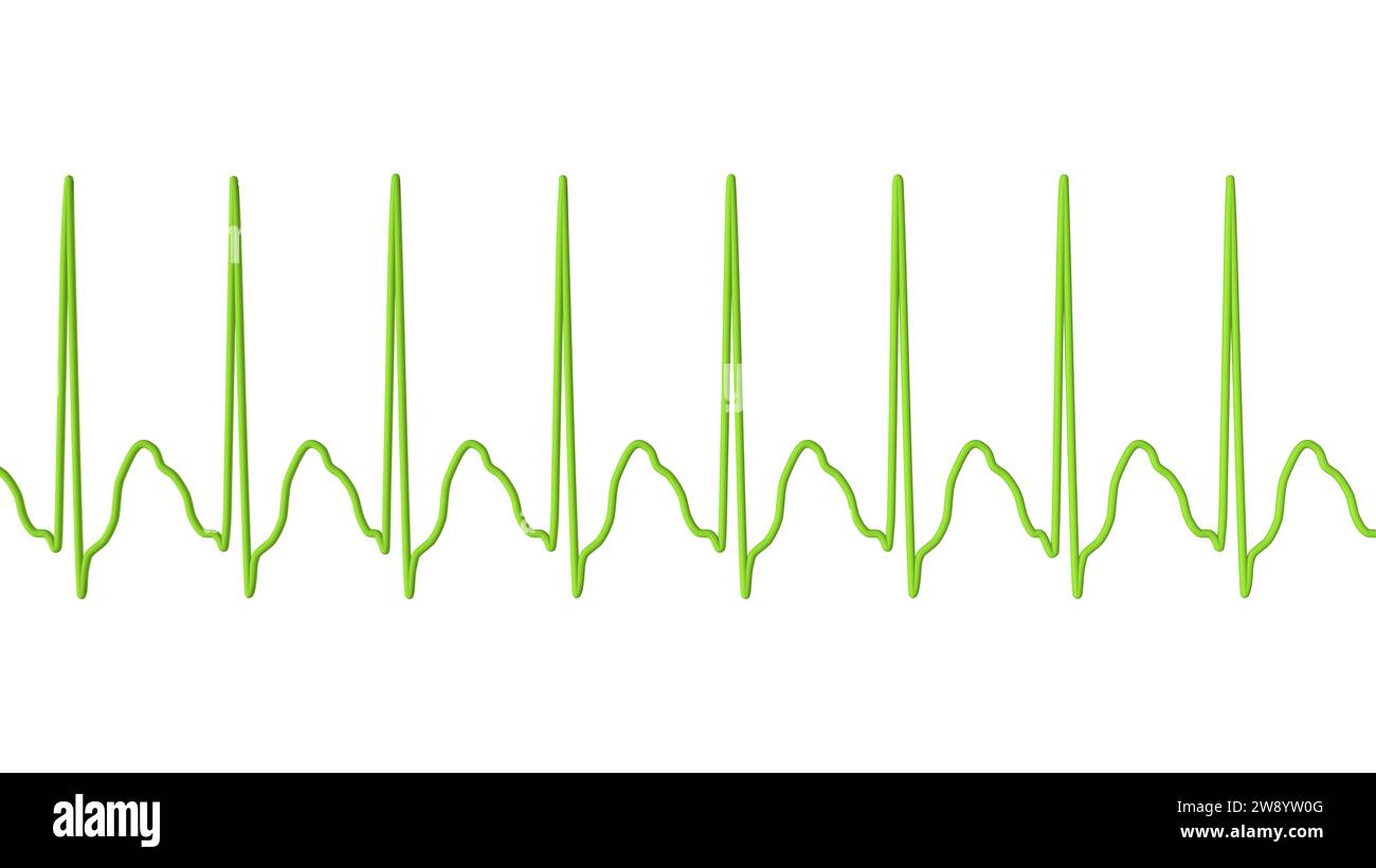 Flutter auriculaire rythme cardiaque anormal, illustration Banque D'Images