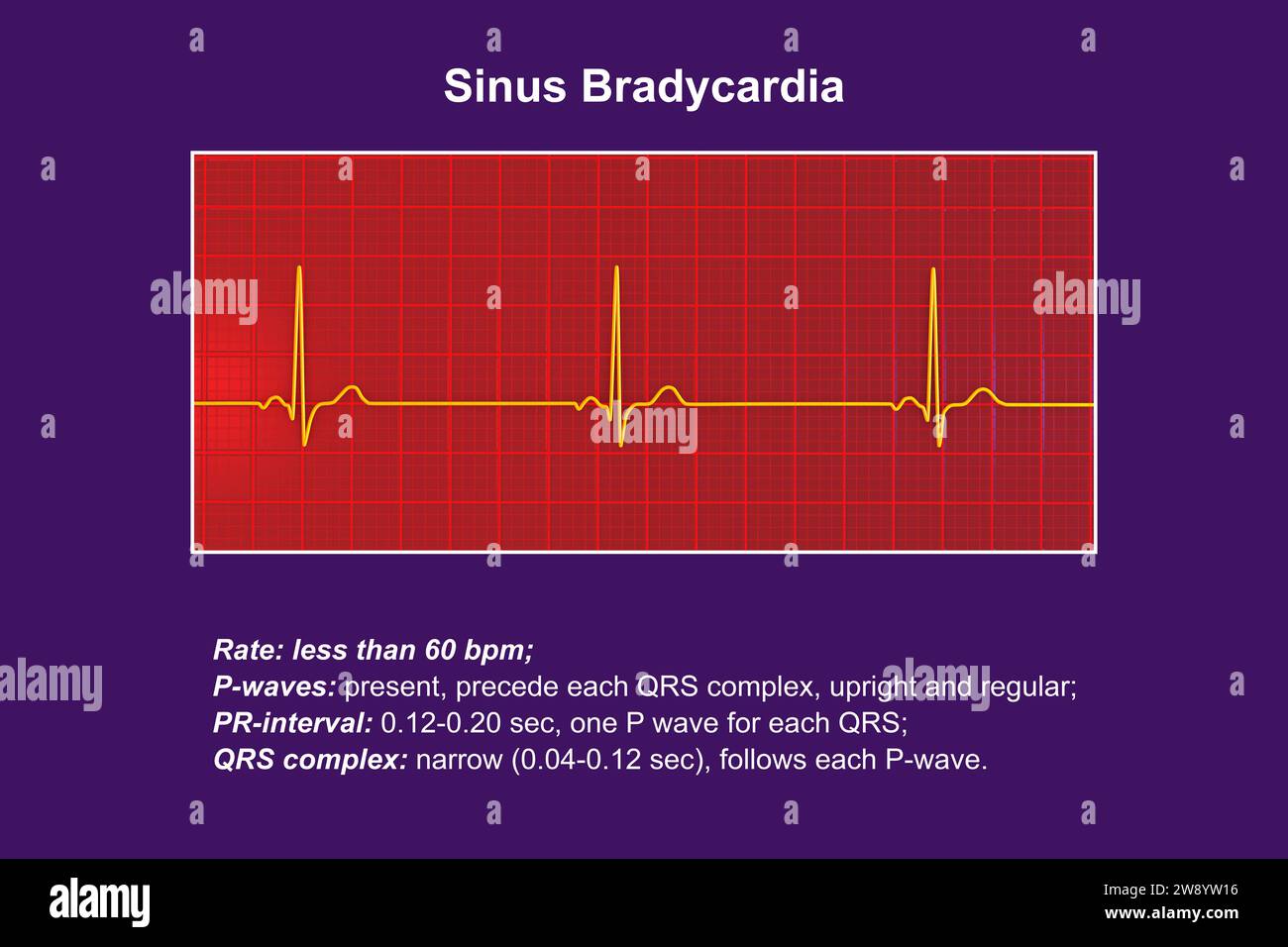 Rythme cardiaque de bradycardie sinusale, illustration Banque D'Images