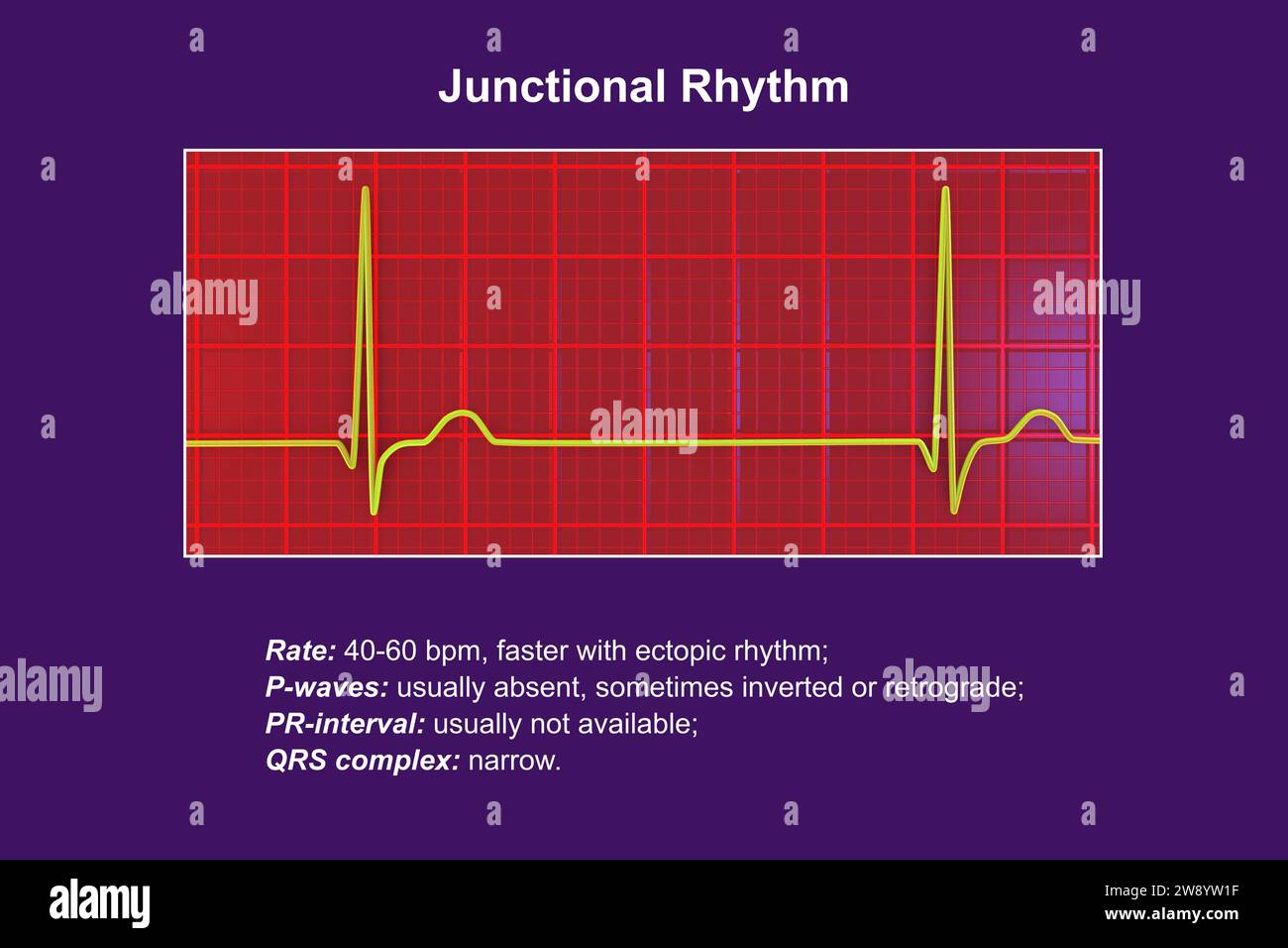 Rythme jonctionnel du rythme cardiaque, illustration Banque D'Images