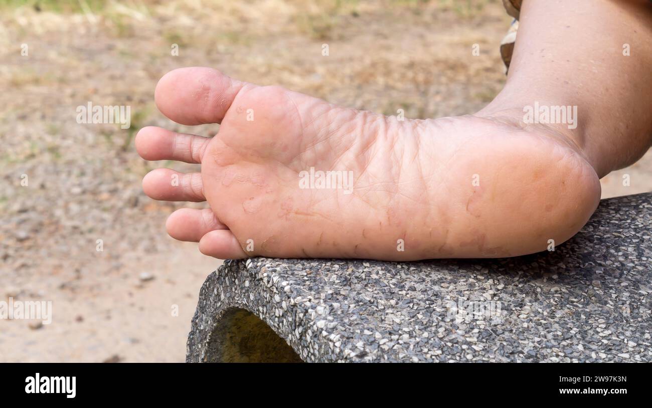 La femme souffre d'une plaie de pied causée par le pied d'athlète. Le patient souffre d'une maladie grave de la peau du pied. Photo rapprochée de la maladie du pied, Concep Banque D'Images