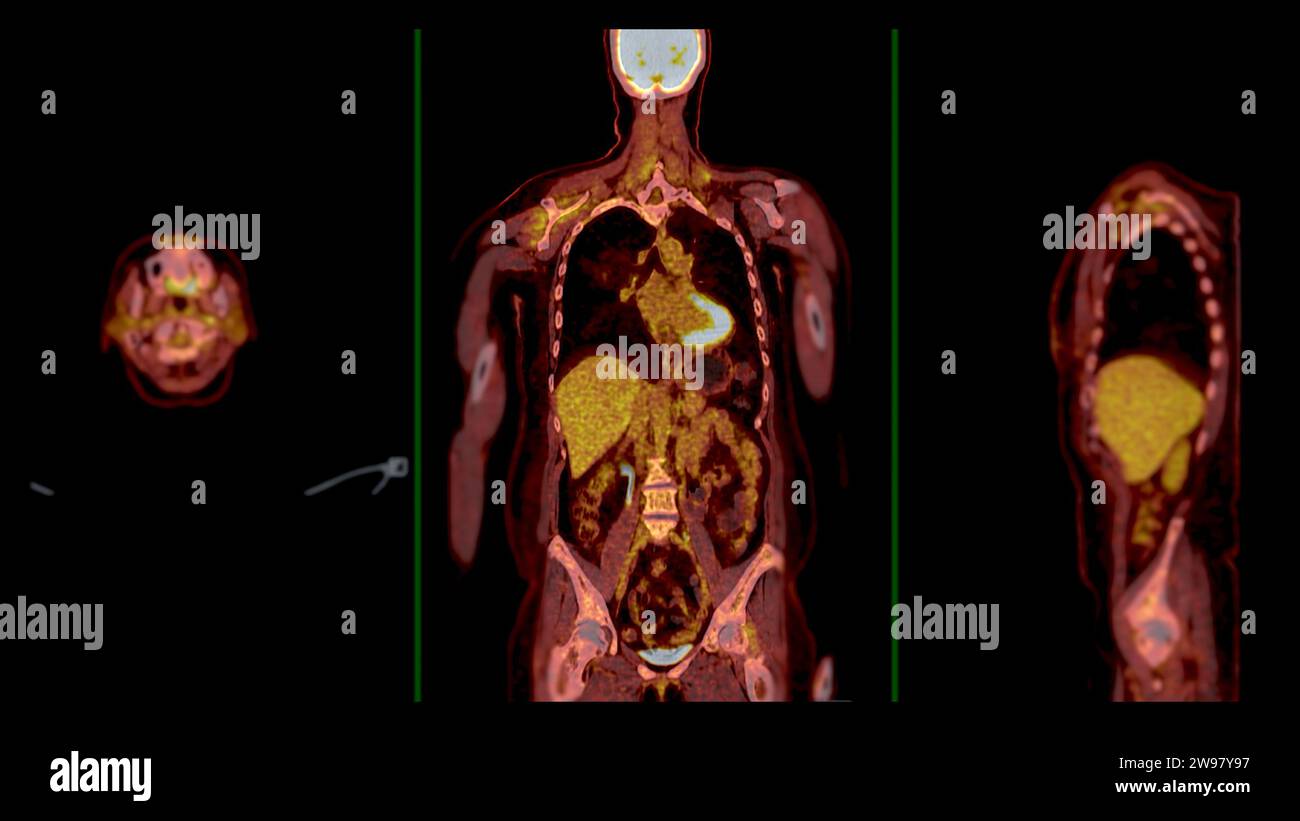Image de fusion d'acquisition PET CT elle fournit des images détaillées ...