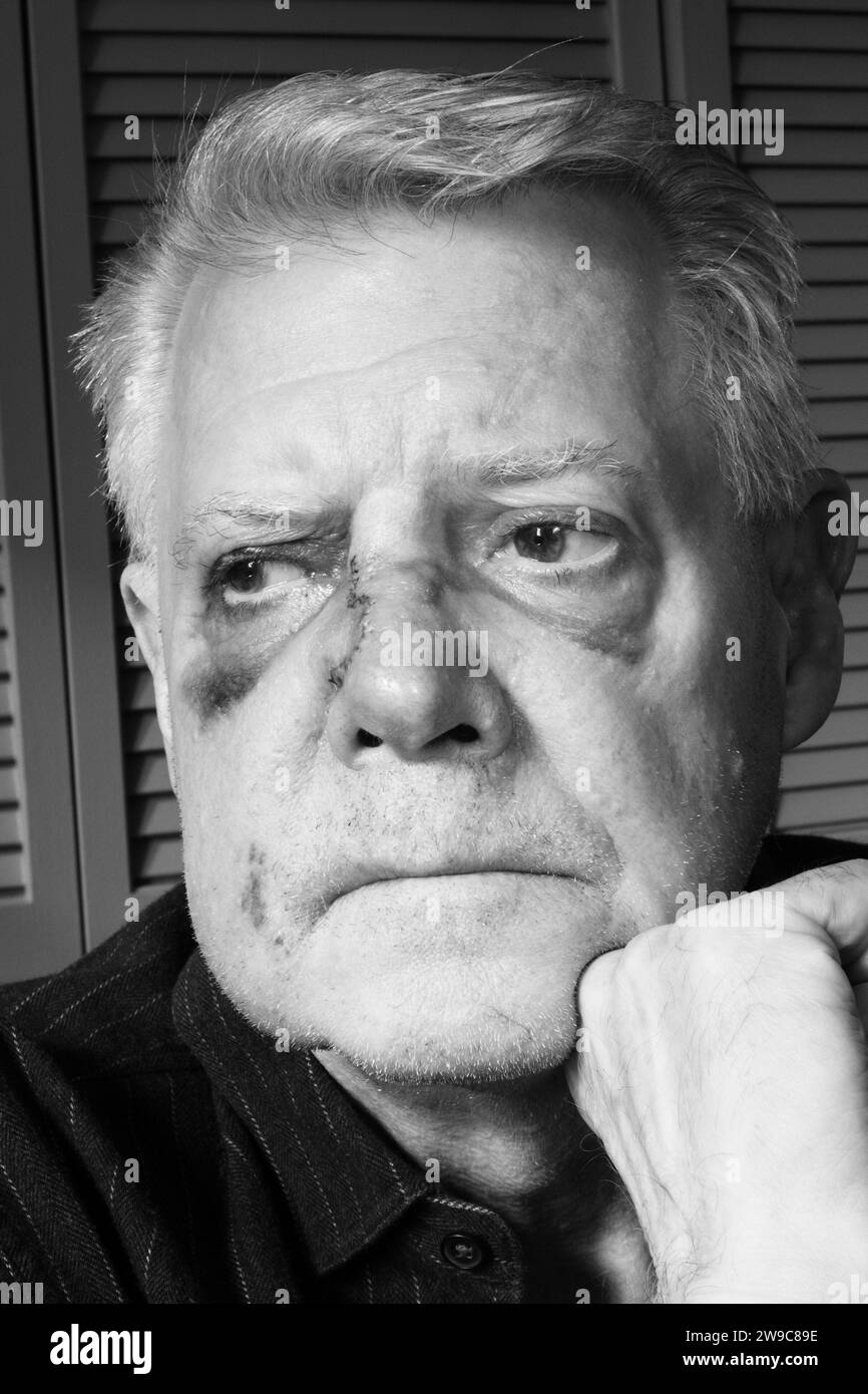Homme âgé, avec des ecchymoses sur le visage, 2024, USA Banque D'Images