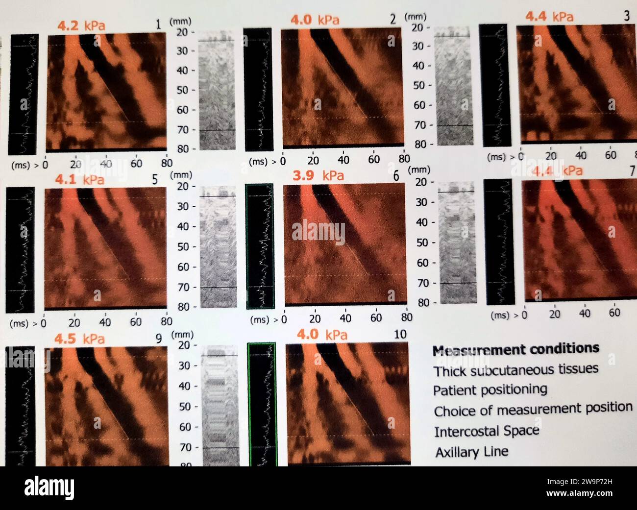 L'étude FibroScan du foie a révélé F0 pour la raideur du foie, S0 pour