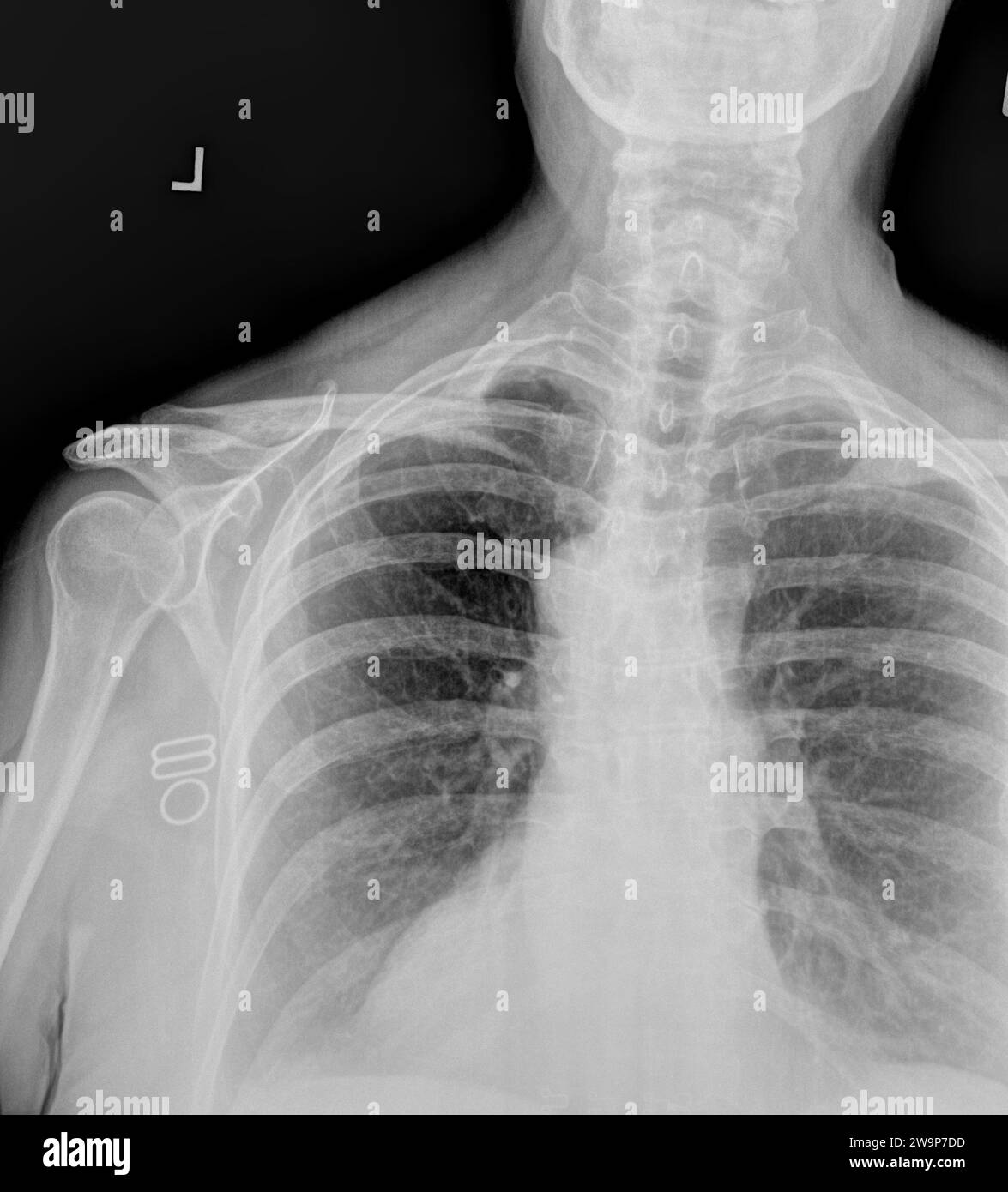 Radiographie ou radiographie d'une vertèbre cervicale adulte normale et de l'épaule gauche. vue antérieure montrant la structure osseuse normale de l'humérus, glénohum crânien Banque D'Images