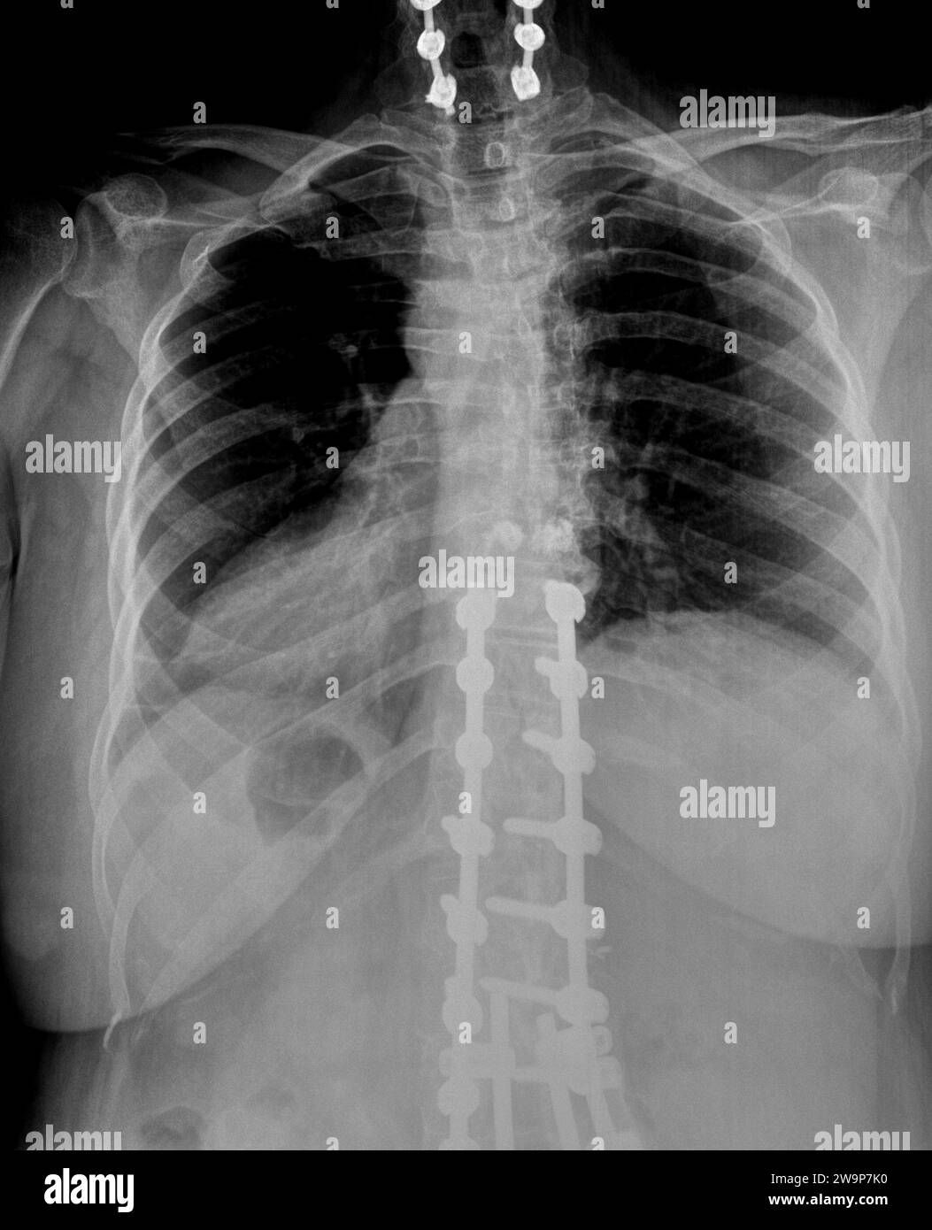 Radiographie ou radiographie d'une partie médiane du dos thoracique et des vertèbres cervicales vue postérieure antérieure montrant un support chirurgical pour aider à stabiliser les patients Banque D'Images