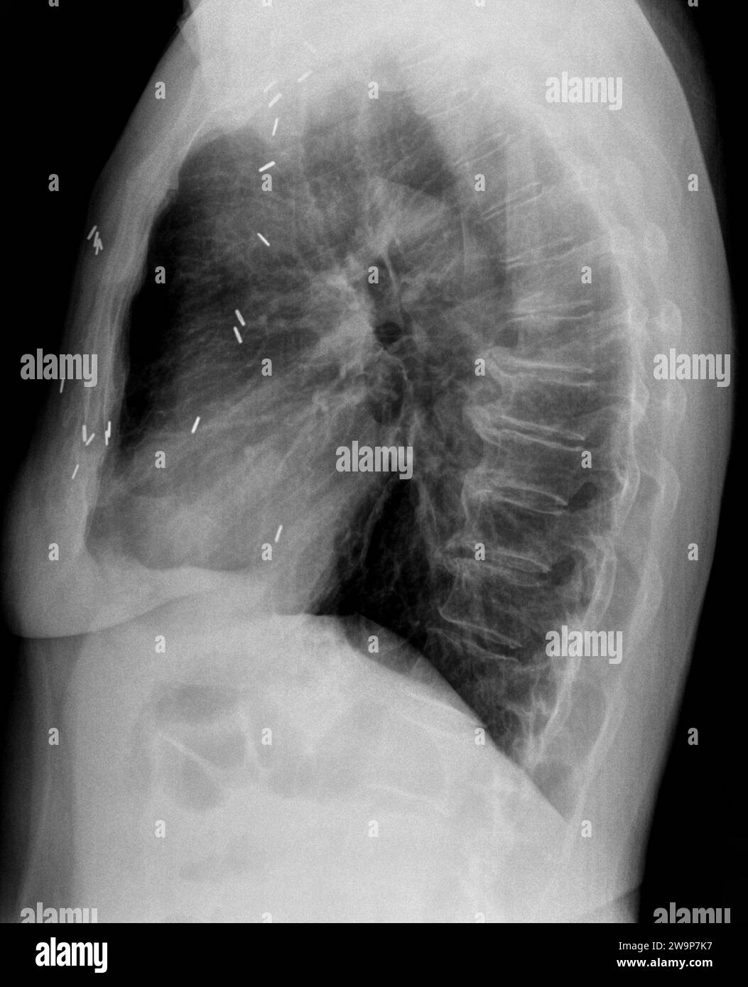 Radiographie ou radiographie filmique d'une vertèbre thoracique médio-dorsale. Vue latérale montrant un artefact d'agrafe chirurgicale résultant d'une chirurgie pulmonaire et d'une dégénérescence du di Banque D'Images