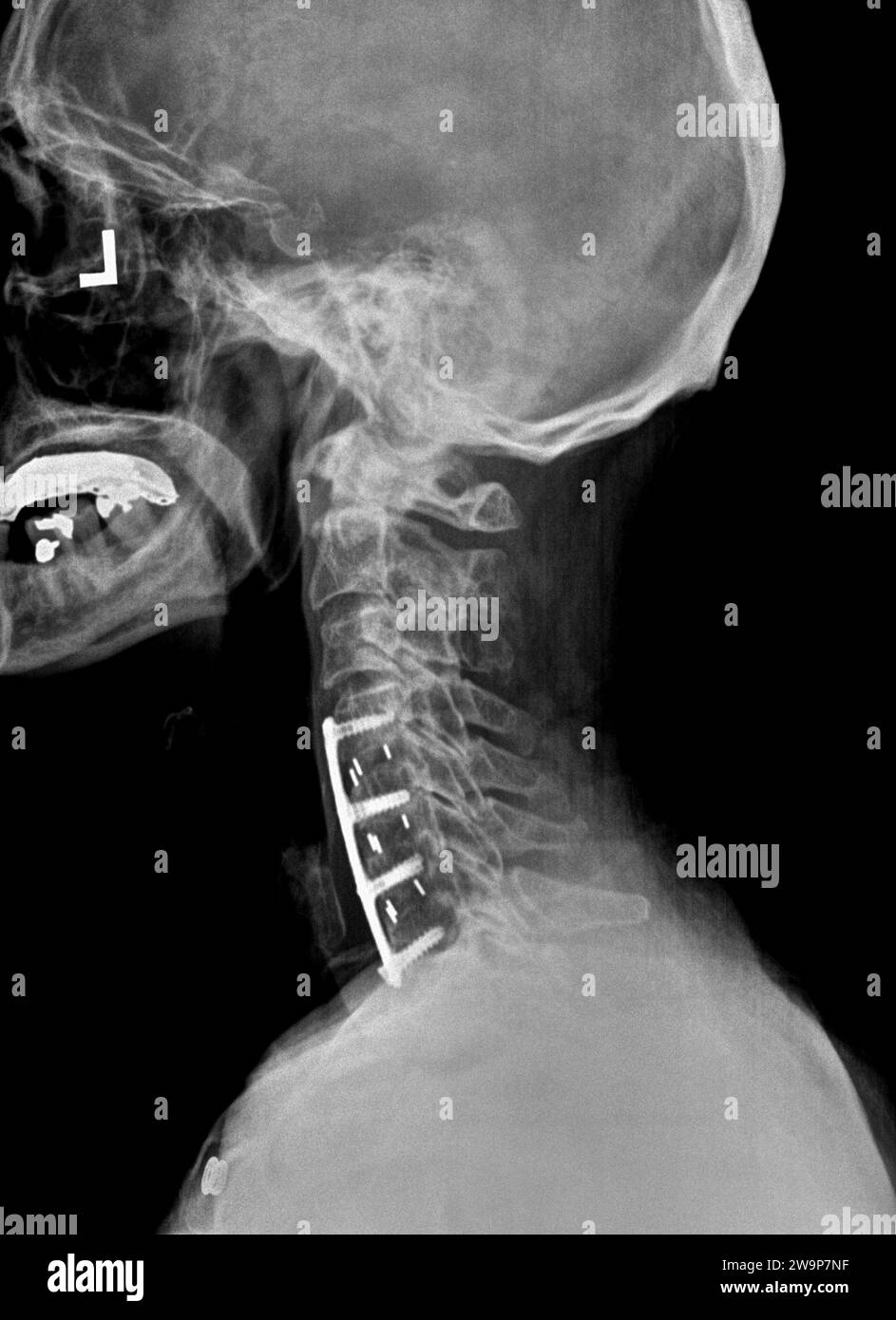 Radiographie ou radiographie filmique d'un col cervical. Vue latérale montrant le support chirurgical pour aider à stabiliser le cou du patient Banque D'Images