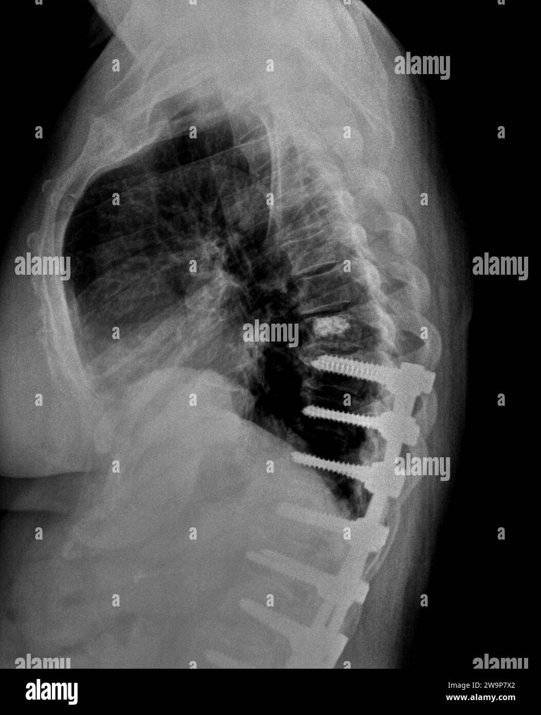 Radiographie ou radiographie filmique d'une vertèbre thoracique médio-dorsale. Vue latérale montrant le support chirurgical pour aider à stabiliser le milieu du dos du patient Banque D'Images