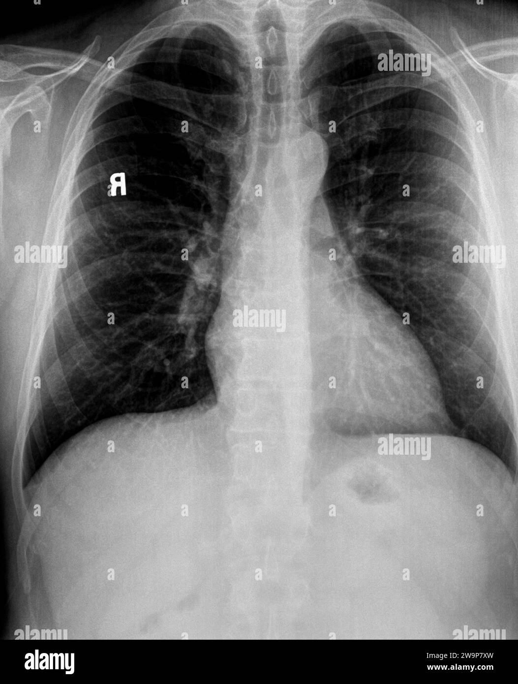 Radiographie thoracique d'un patient avec poumons emphysémateux, adénopathie Hilaire montrant le cœur, les vertèbres et les vaisseaux pulmonaires Banque D'Images