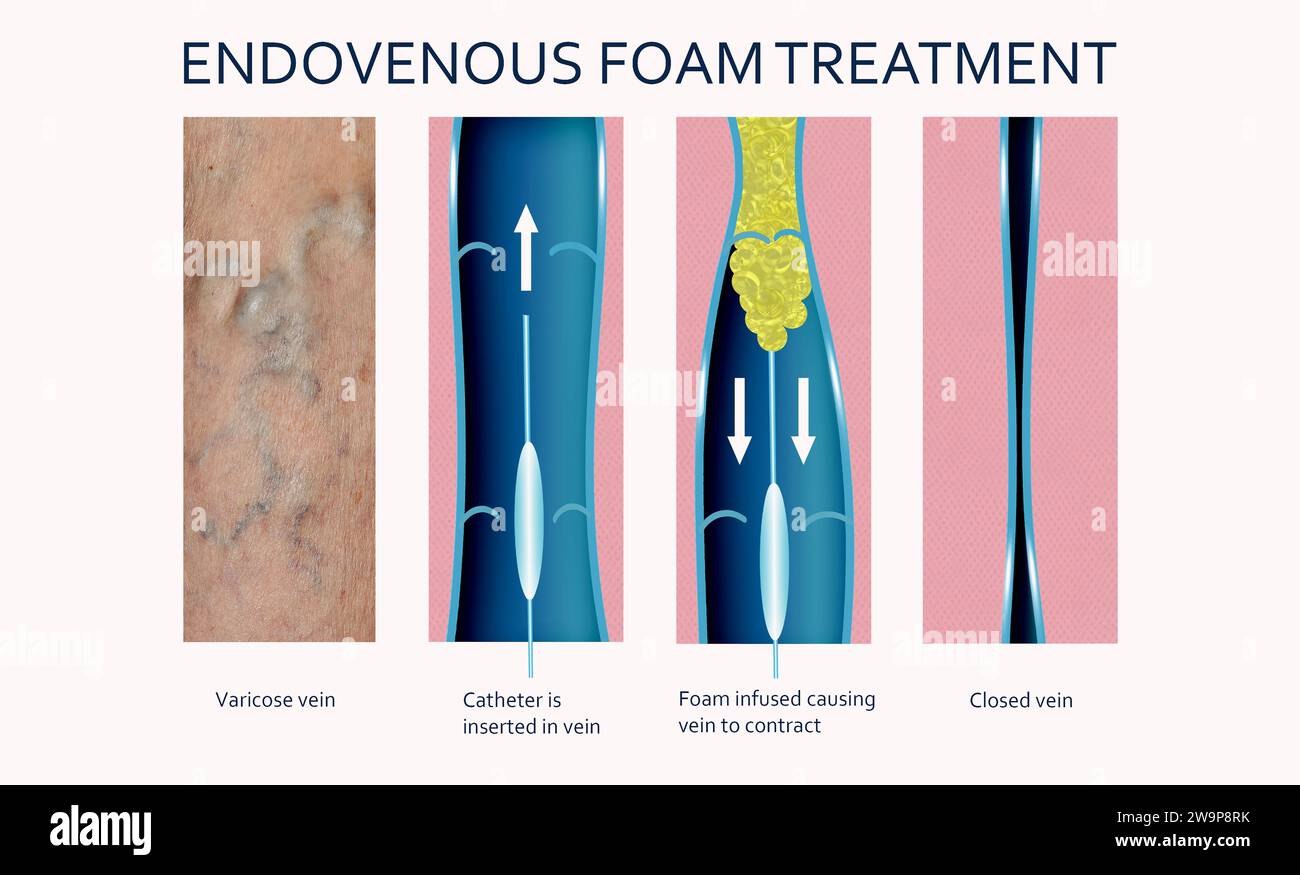 Traitement endoveineux au laser des varices - concept de sclérothérapie à mousse. Avant et après. Structure veineuse Banque D'Images